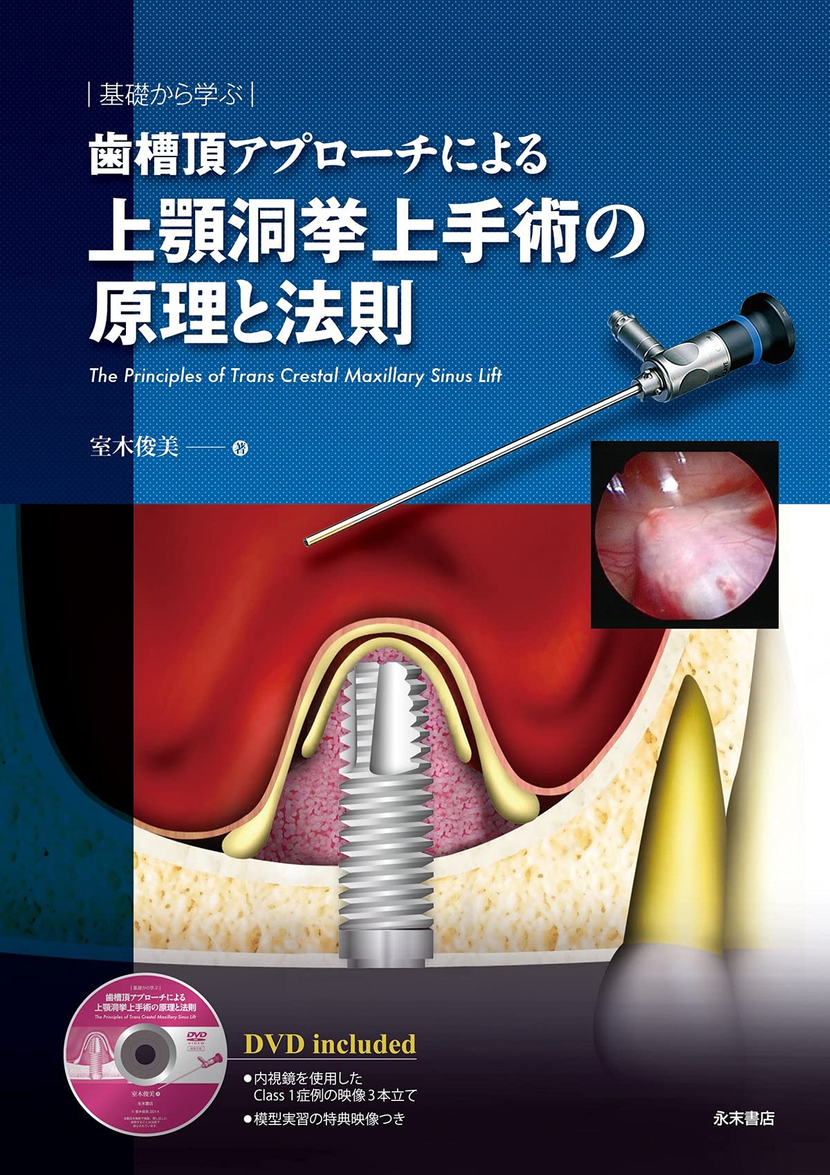 Perfect Sinus Lift - 上顎洞底挙上術のすべて 基礎から学ぶ 歯槽頂