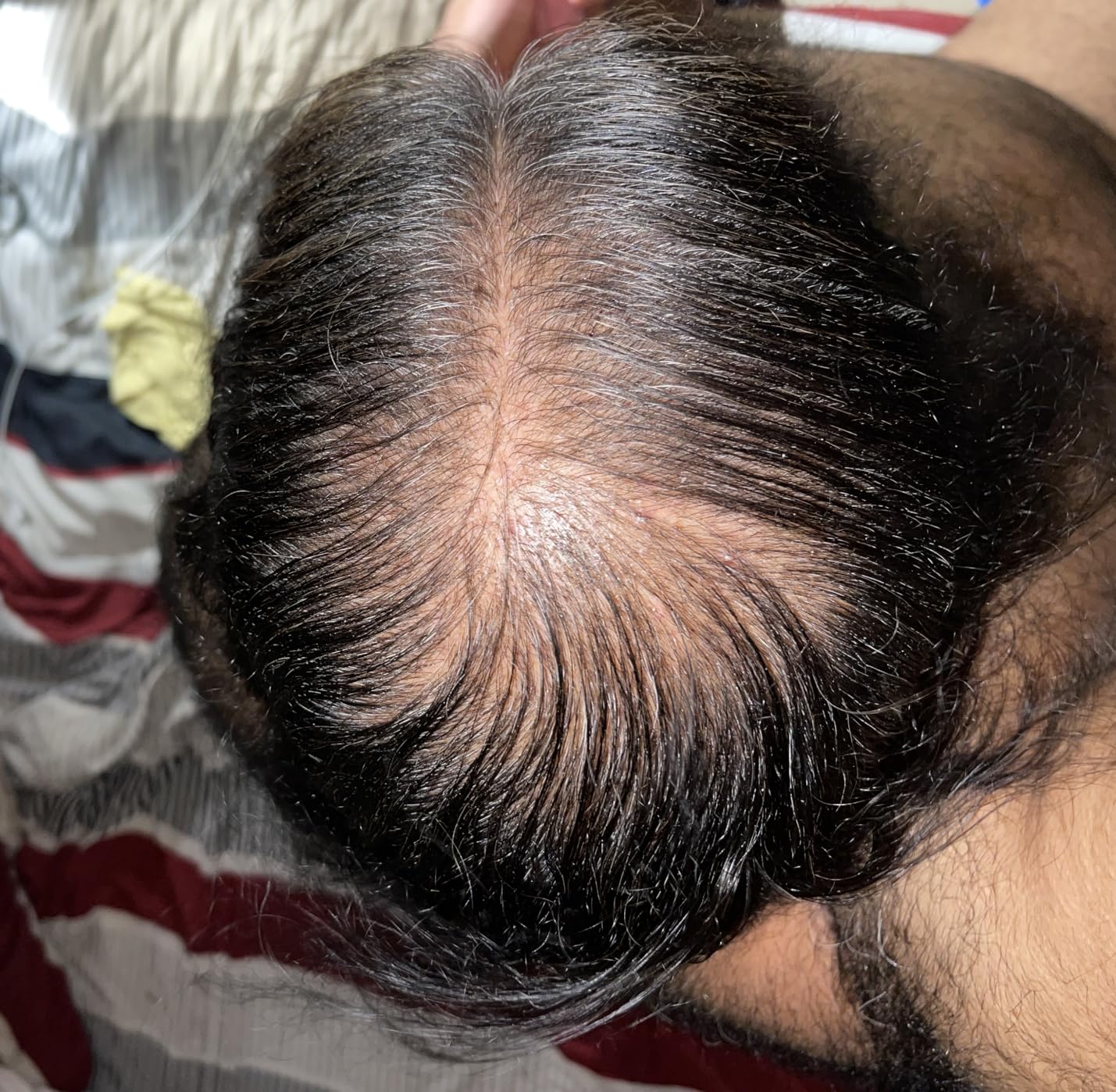6 Meses de Tratamiento - Resultados Minoxidil Argentina