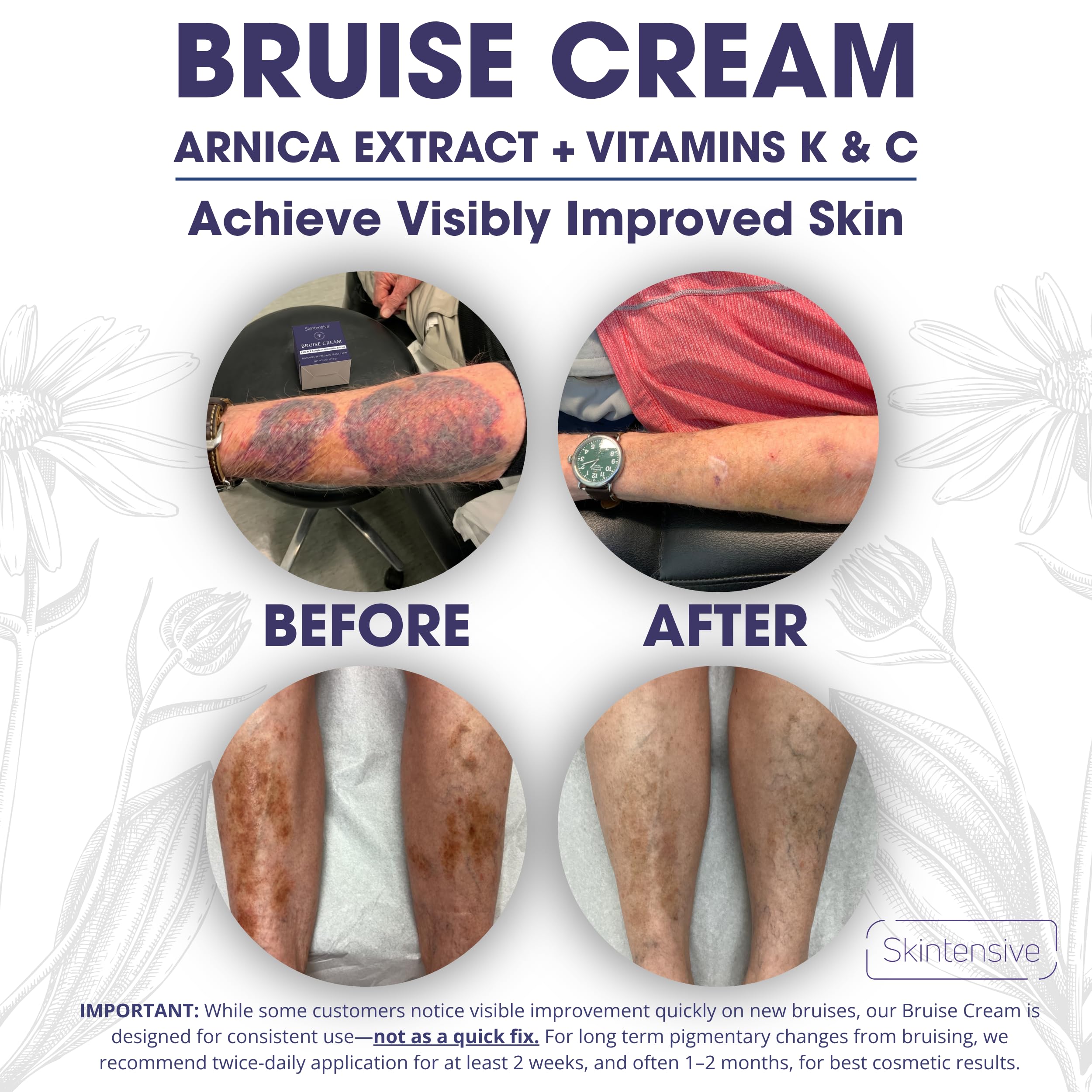 SKINTENSIVE Arnica Bruise Cream for Thin Skin – Vitamin K Cream for Bruises & Skin Discoloration, Moisturizing Arnica Cream, Non-Greasy Formula, 4 Oz — Amazon image 6