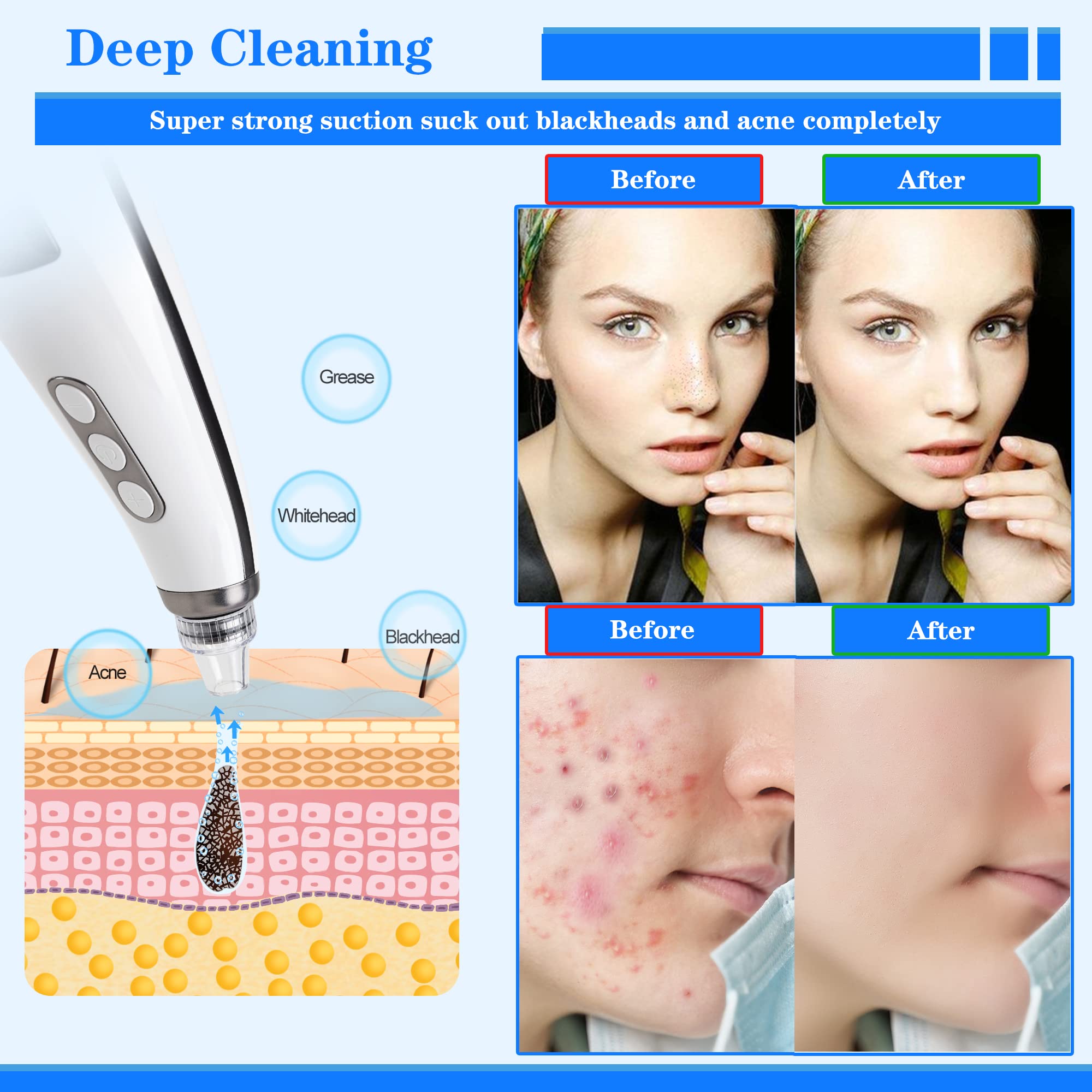 2023 più nuovo aspirapolvere Tunbot per i punti neri, strumento ricaricabile per l'estrazione dei punti neri - 5 potenza di aspirazione, 5 sonde per pelli sensibili all'acne, grasse, secche, sensibili