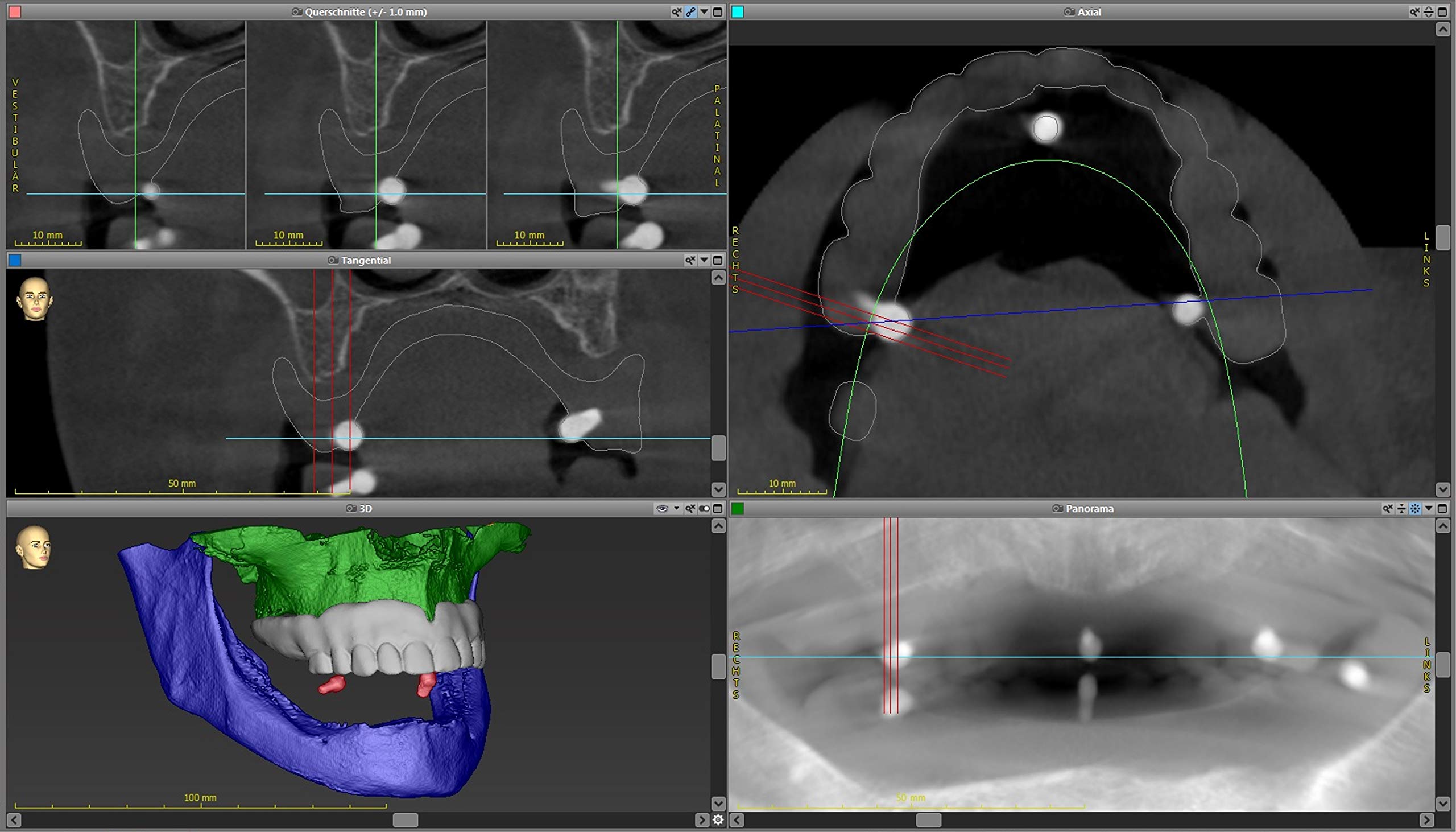 Röntgenkugeln aus bariumsulfathaltigem Kunststoff für CT, DVT (7)