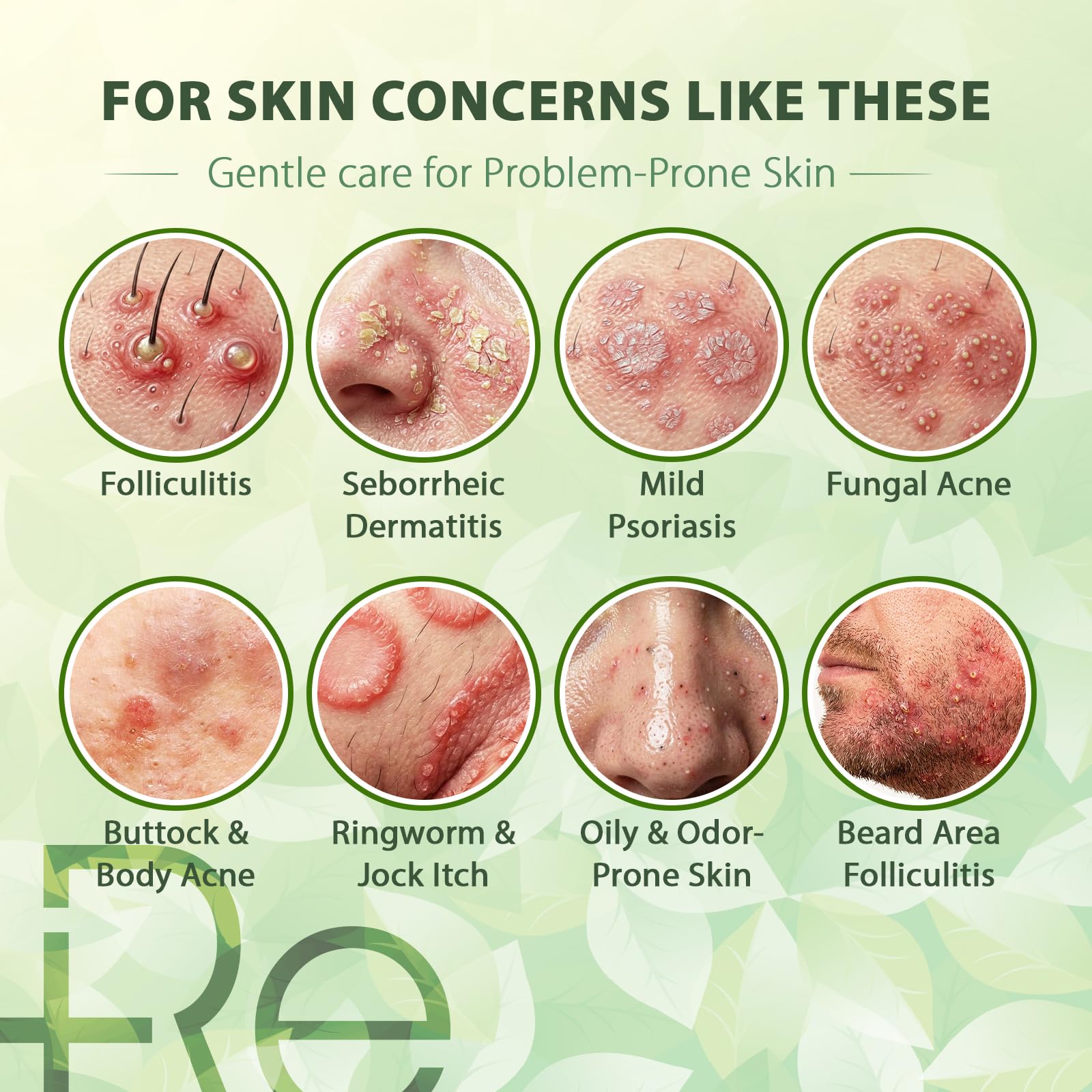 Antifungal Body Wash Antibacterial Soap: Shower Gel for Blemish-Prone & Itchy Skin, Helps Cleanse Skin Prone to Fungal & Irritation-Related Concerns – For Men & Women with 12 Botanical Extracts (300 ml (Pack of 1), Herbal Floral) - 5