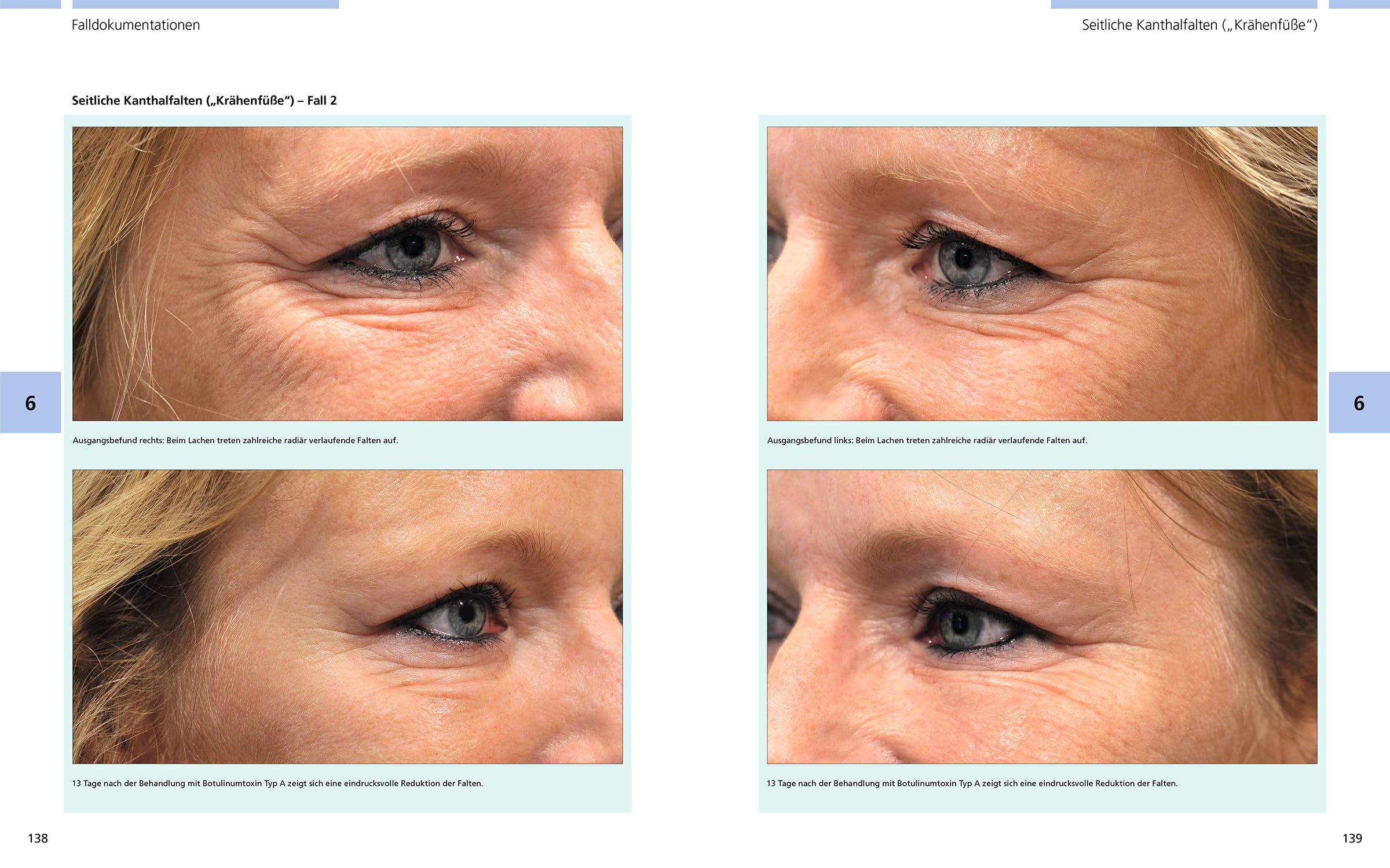 Bildatlas der ästhetischen Botulinumtoxin-Therapie: Dosierung | Lokalisation | Anwendung