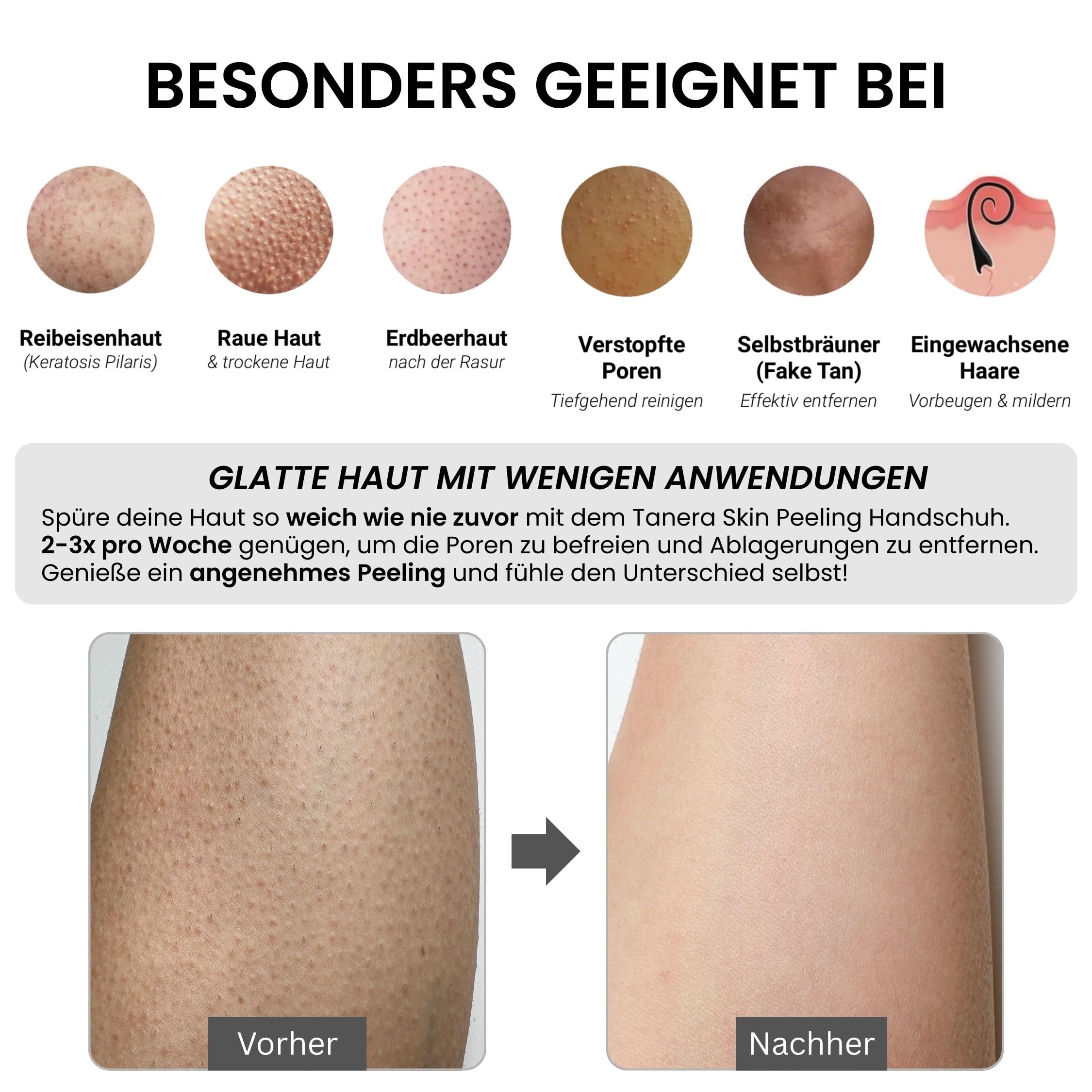 Peeling Handschuh Original Die Höhle der Löwen Kessa Hamam Body Scrub bei Keratosis Pilaris, Erdbeerbeine