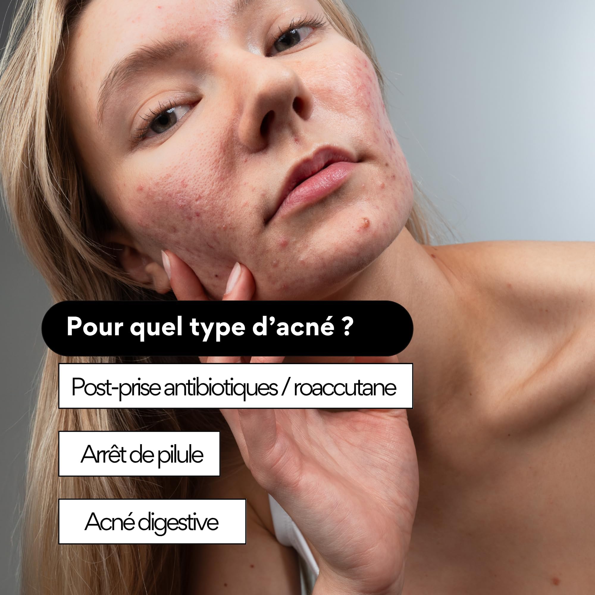 Skin & Out - Complément Alimentaire Stop-Boutons - Complément Alimentaire Nettoyant