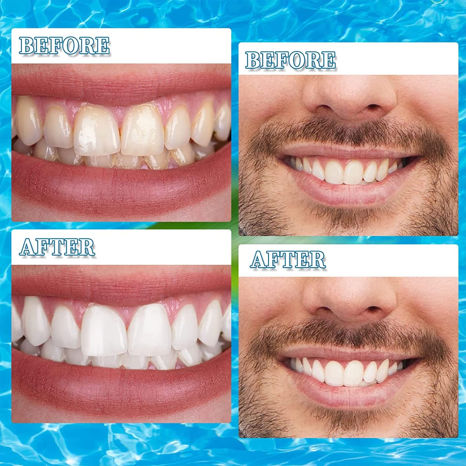 Protesi Dentale Naturale Gel di Silice Faccette Dentali Inferiore e Superiore Cosmetici Denti Ripara Istantaneamente i Denti e Sorridi per Uomini e Donne,4 Pairs