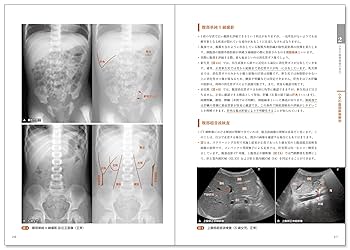 レジデントのための腹部画像教室【小児急性腹症の見方】 | 野坂