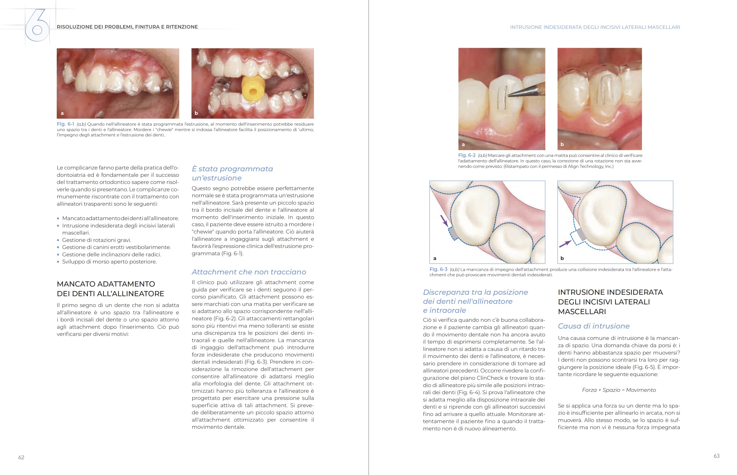 Allineatori trasparenti. Biomeccanica e gestione clinica