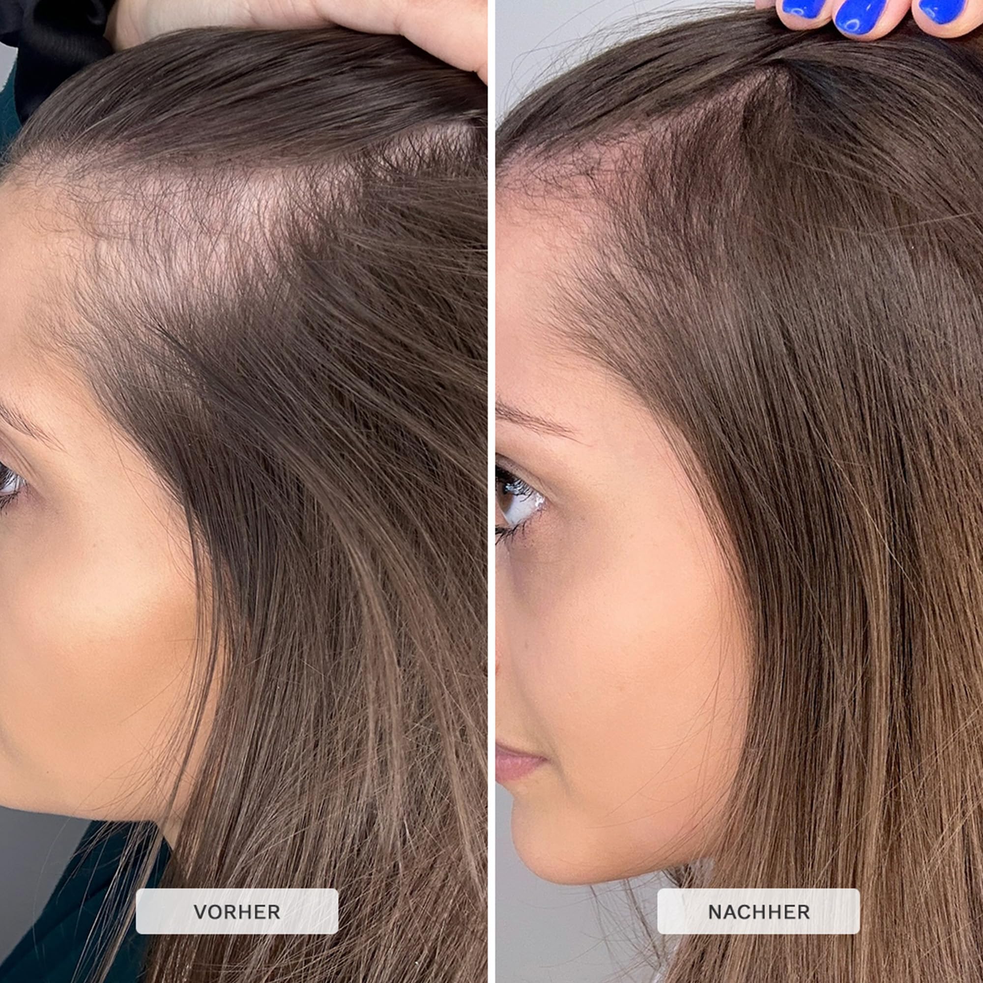 HAIR BURST Haar & Kopfhaut Serum - Rosmarinöl & Capixyl, Haarwachstum