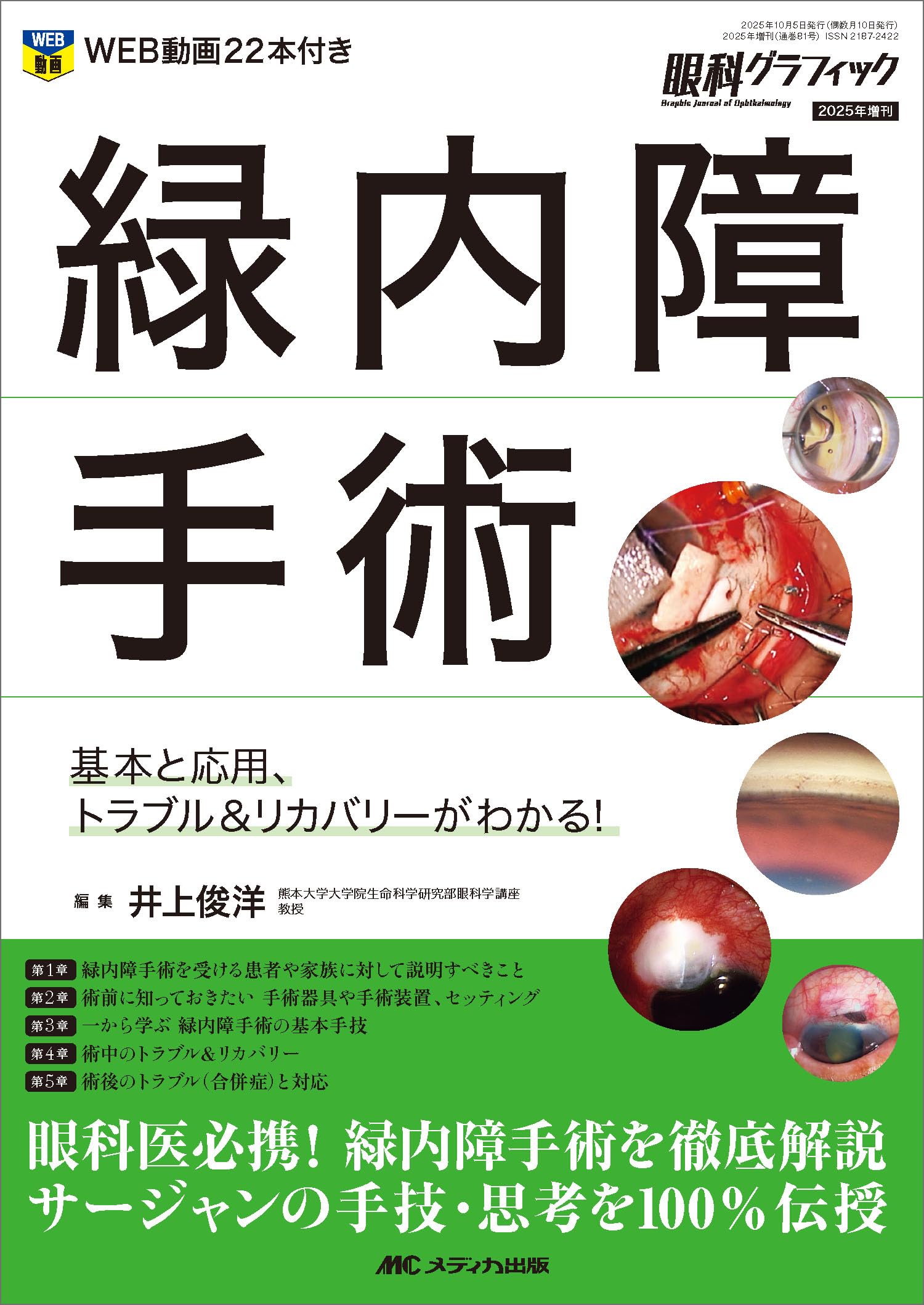 緑内障手術：基本と応用、トラブル＆リカバリーがわかる！ (眼科