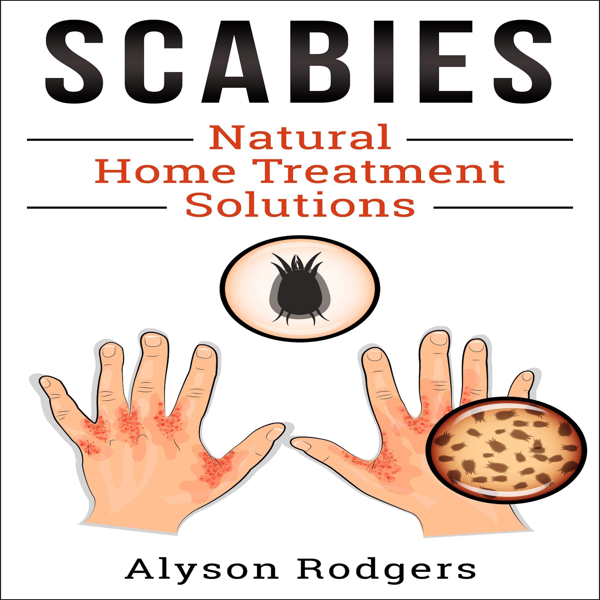 Scabies Natural Home Treatment Solution