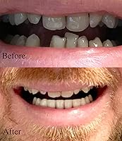 Vista 2 de Instant Smile Dientes inferiores cosméticos profesionales: nuevo con detalles hechos a mano, ajuste personalizado en casa