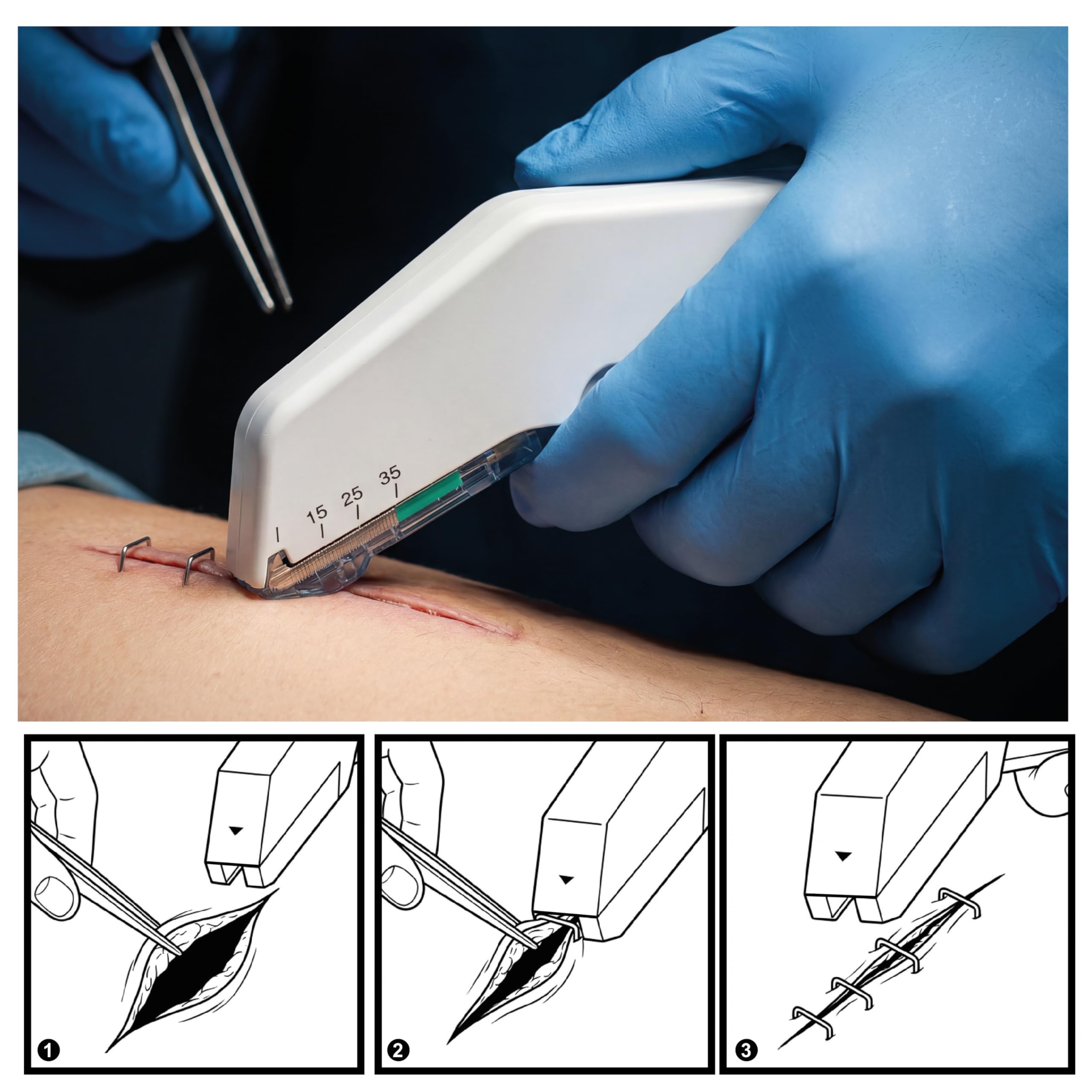 KMINA Grapadora para Sutura Cutánea (5 Unidades), 35 Grapas Estériles, Acero Inoxidable, Diseño Ergonómico, Libre de Látex, Apertura Fácil, Pack con Envases Individuales