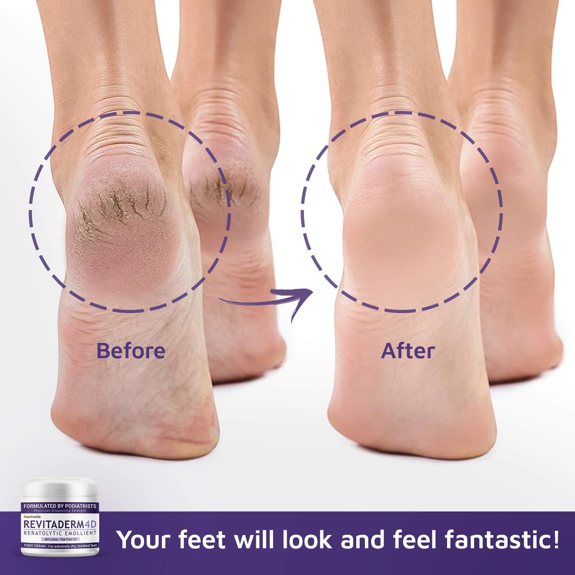 Buy Revitaderm Urea Foot Cream 40 Percent For Dry Cracked Feet, Hands