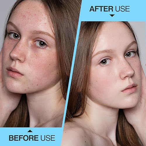 Miniatura 6 de Kit profesional para eliminar espinillas, 100 agujas desechables para el acné, herramientas para eliminar puntos negros, herramienta extractora de