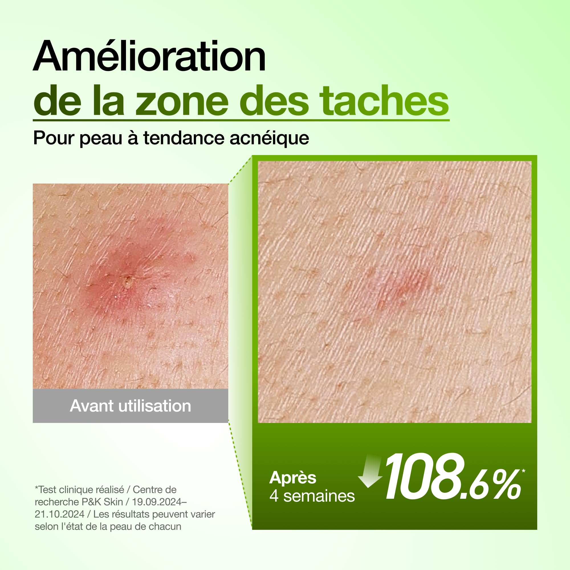 Anua Sérum Acide Azélaïque 10% – Serum Visage Apaisant Rougeurs & Imperfections, Acide Hyaluronique & Niacinamide, Peau Sensible, Skincare Coréenne, (30ml/ 1.01 fl oz.)