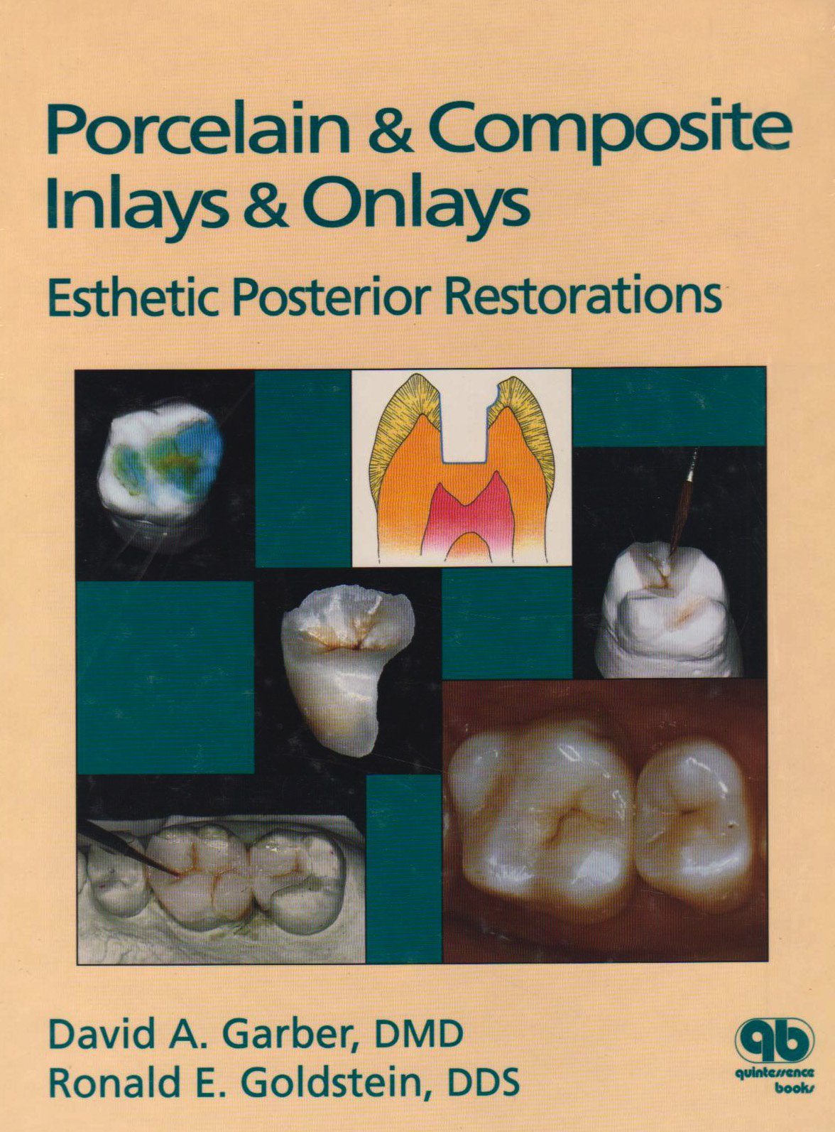 Buy Porcelain & Composite Inlays & Onlays: Esthetic Posterior Restorations — BookShops.in