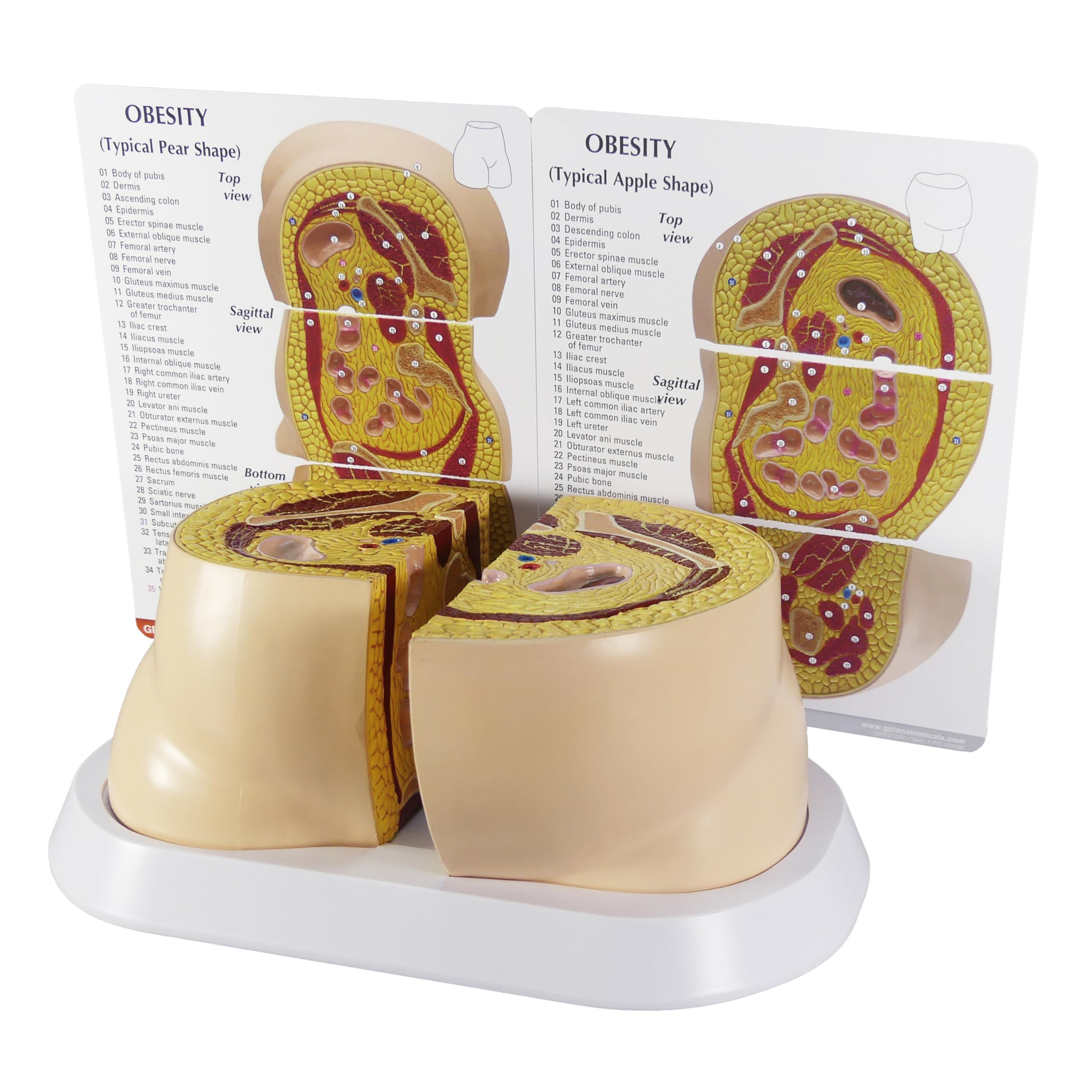 GPI Anatomicals - Obesity Model, Replica of The Hip Area Depicting Effects of Obesity for Human Anatomy and Physiology Education, Anatomy Model for Doctor's Offices, Medical Learning Resources