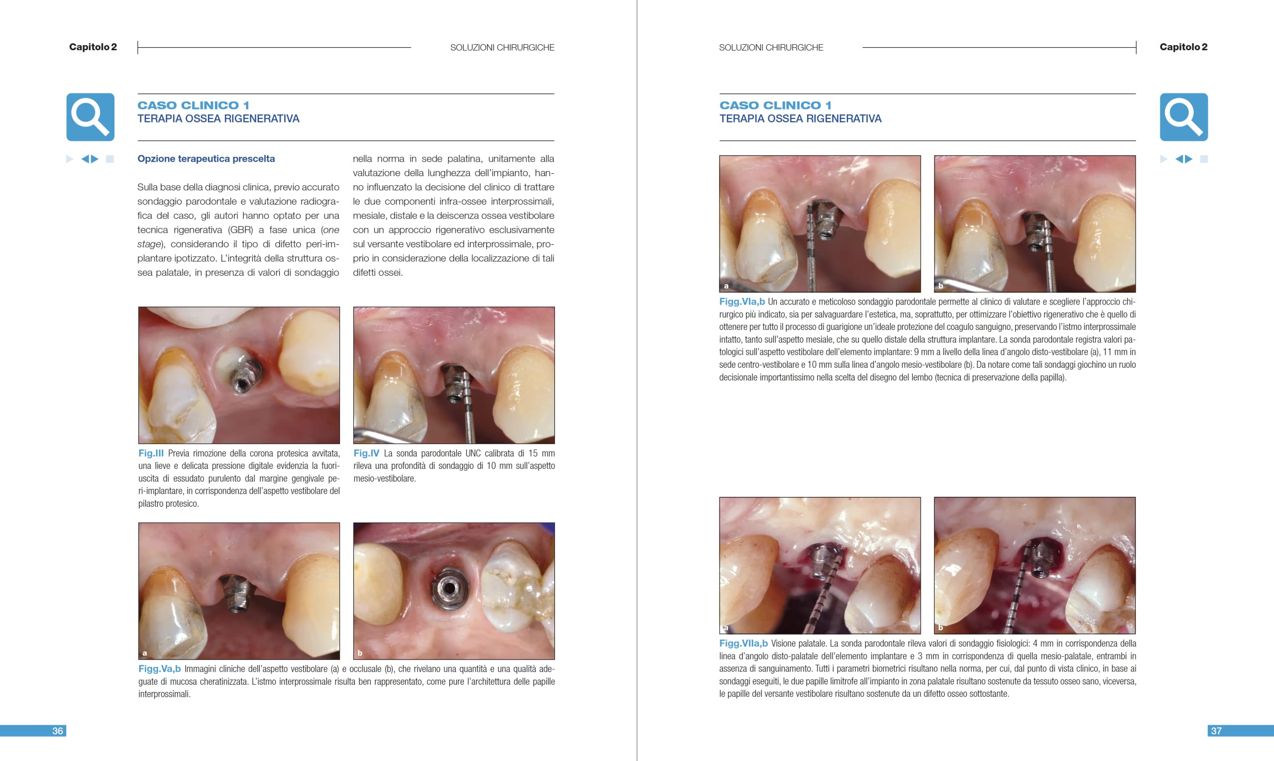 Malattie peri-implantari. Trattamenti chirurgici