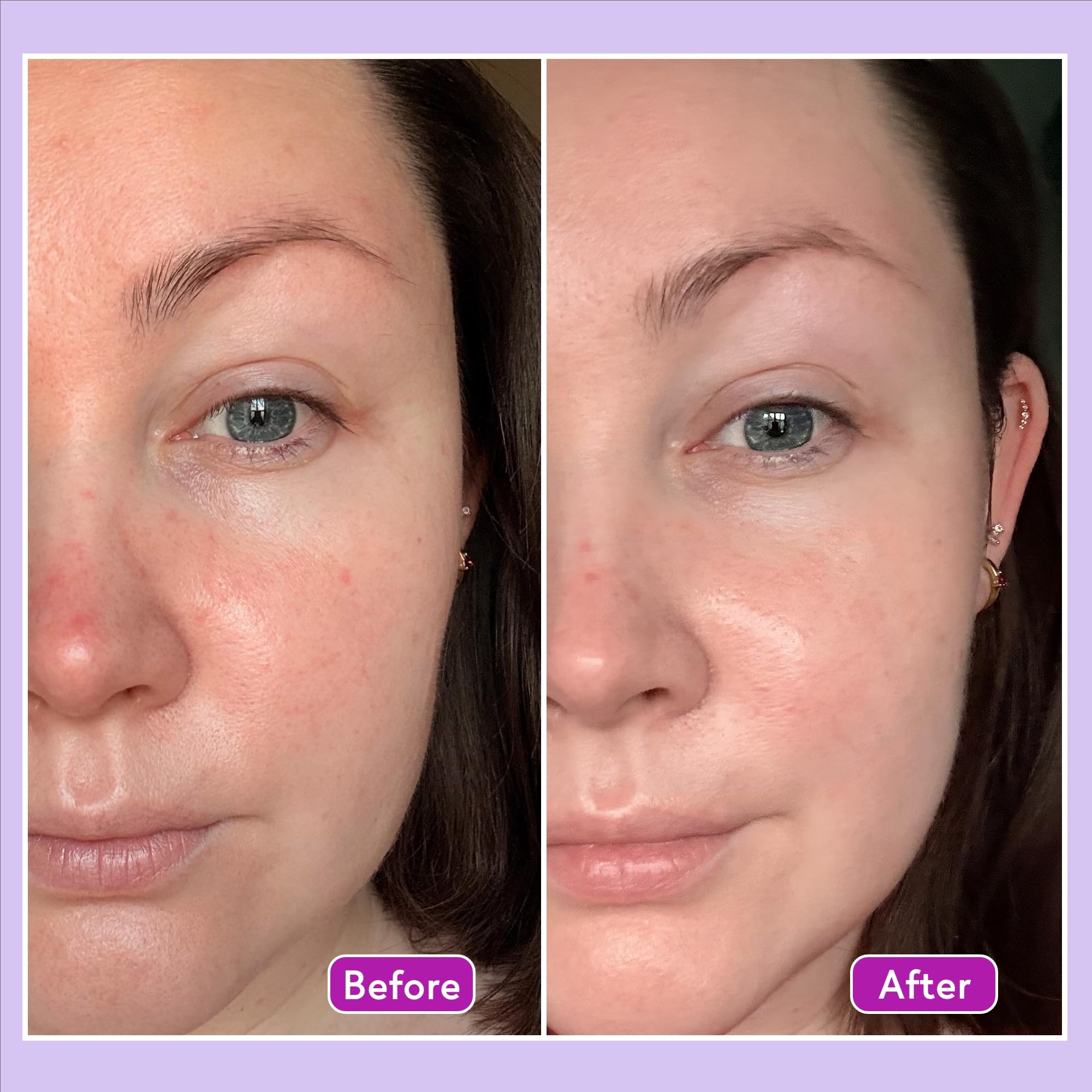 Q+A azelainowym Serum wyrównujące pH, zawierające cynk PCA minimalizujący pory i antyoksydanty dla odświeżonej i gładszej skóry, 30 ml.