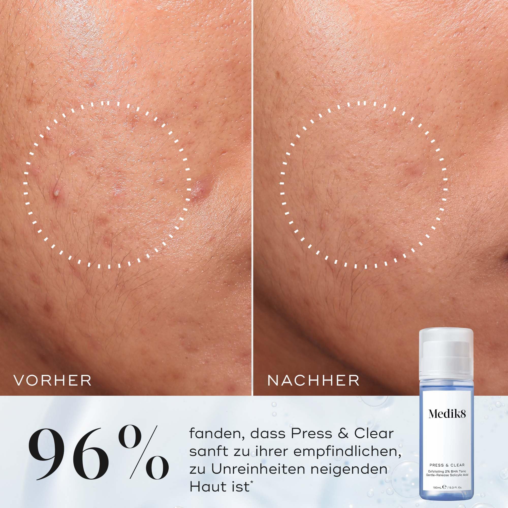 Medik8 Press & Clear, 2% BHA Klärendes Gesichtswasser - 150 ml Refill