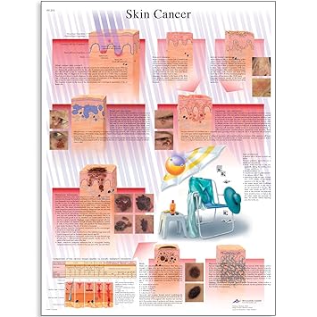3B Scientific VR1295L Glossy Laminated Paper Skin Cancer Anatomical Chart, Poster Size 20