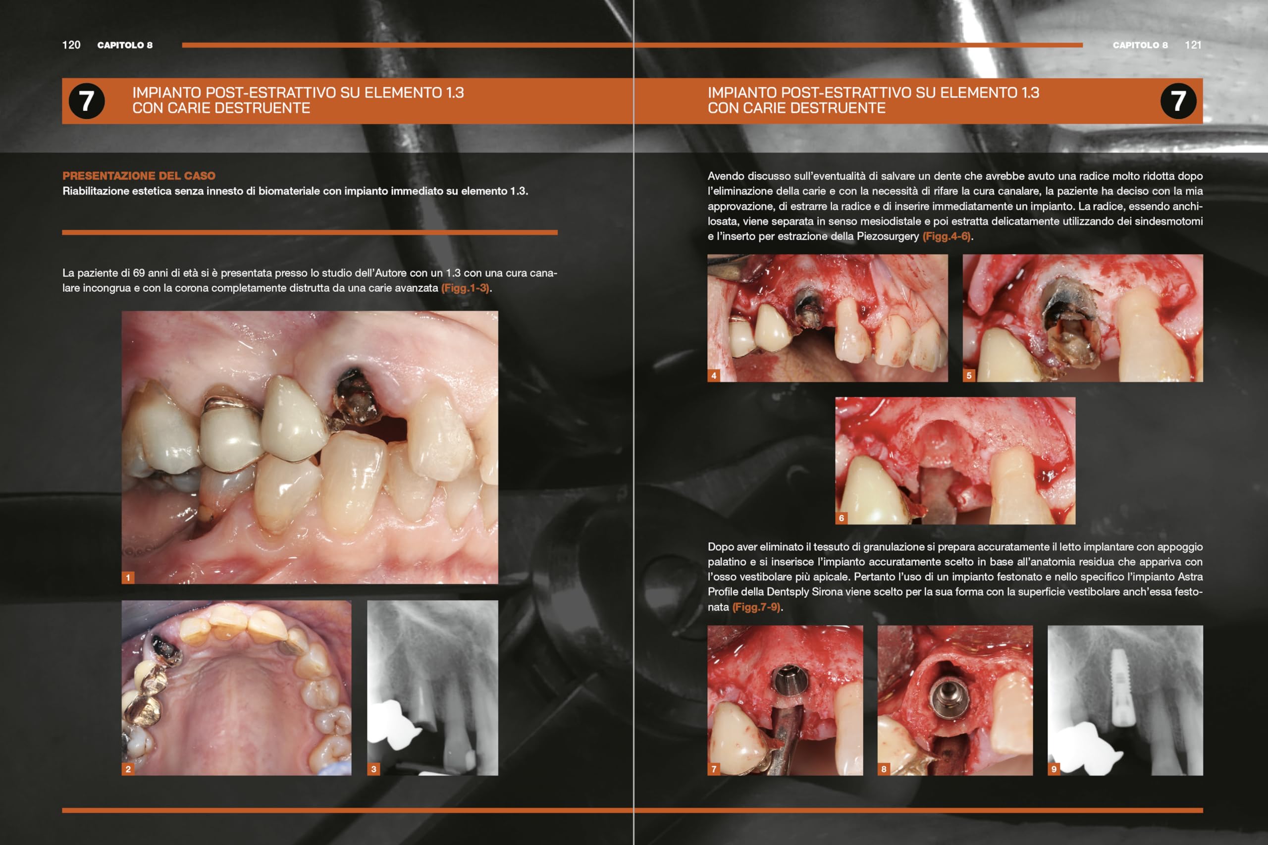 Impianti immediati. Manuale clinico operativo con procedure step by step