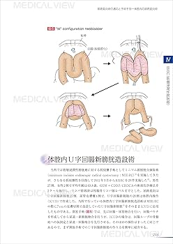 【医学専門書】膀胱の手術 膀胱全摘除術と新膀胱造設術−Studer変法を究める [DVD付] | 望