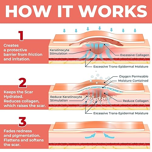 Miniatura 6 de Hojas de silicona de grado médico para cicatrices – Paquete de 6 unidades (7 x 1.6 pulgadas) – Diferencia visible en cicatrices de cesárea – Hojas