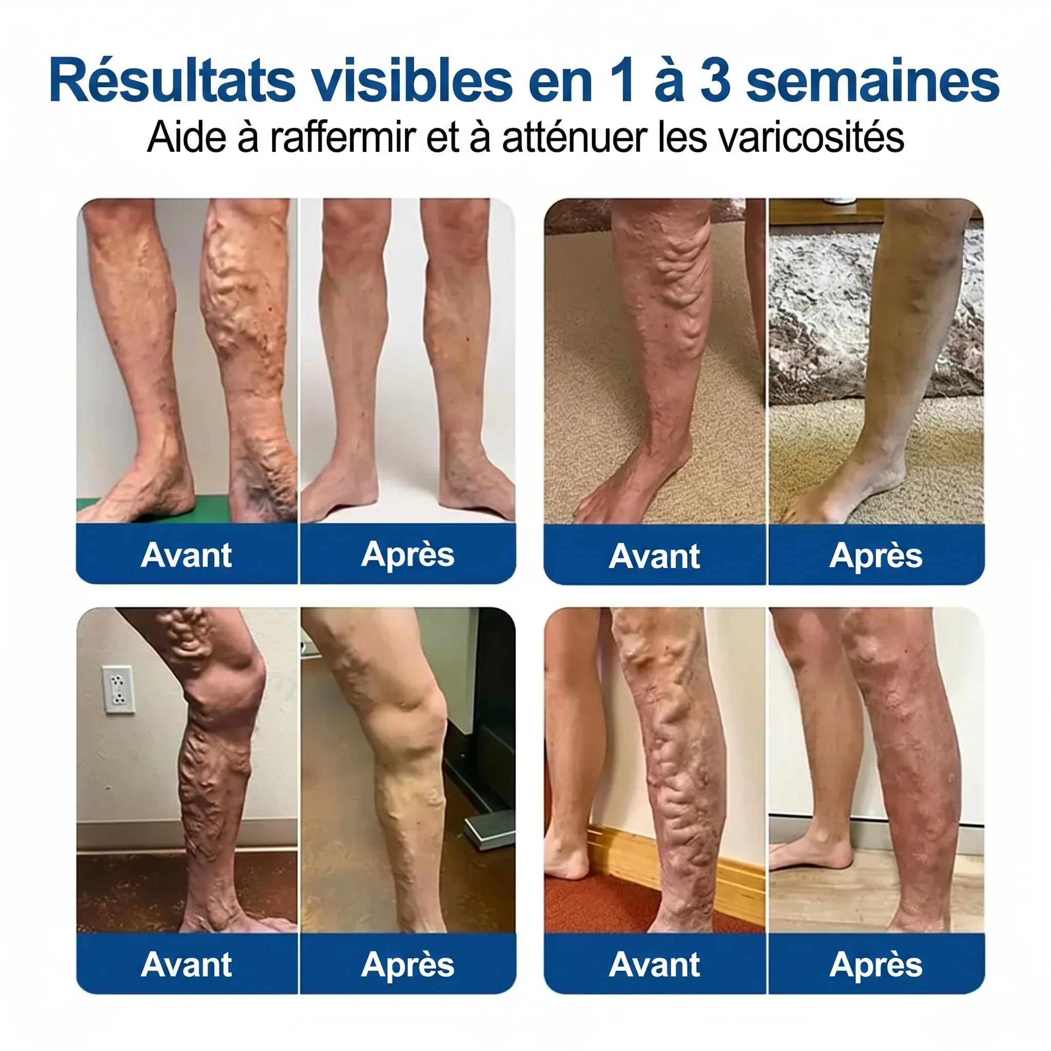 vaduma Patch Anti-Varices Patchs nourrissants pour les jambes - Soins de peau pour stimuler la mobilité - Ensemble de 12 patchs avec absorption profonde - Coussinets de traitement aux extraits