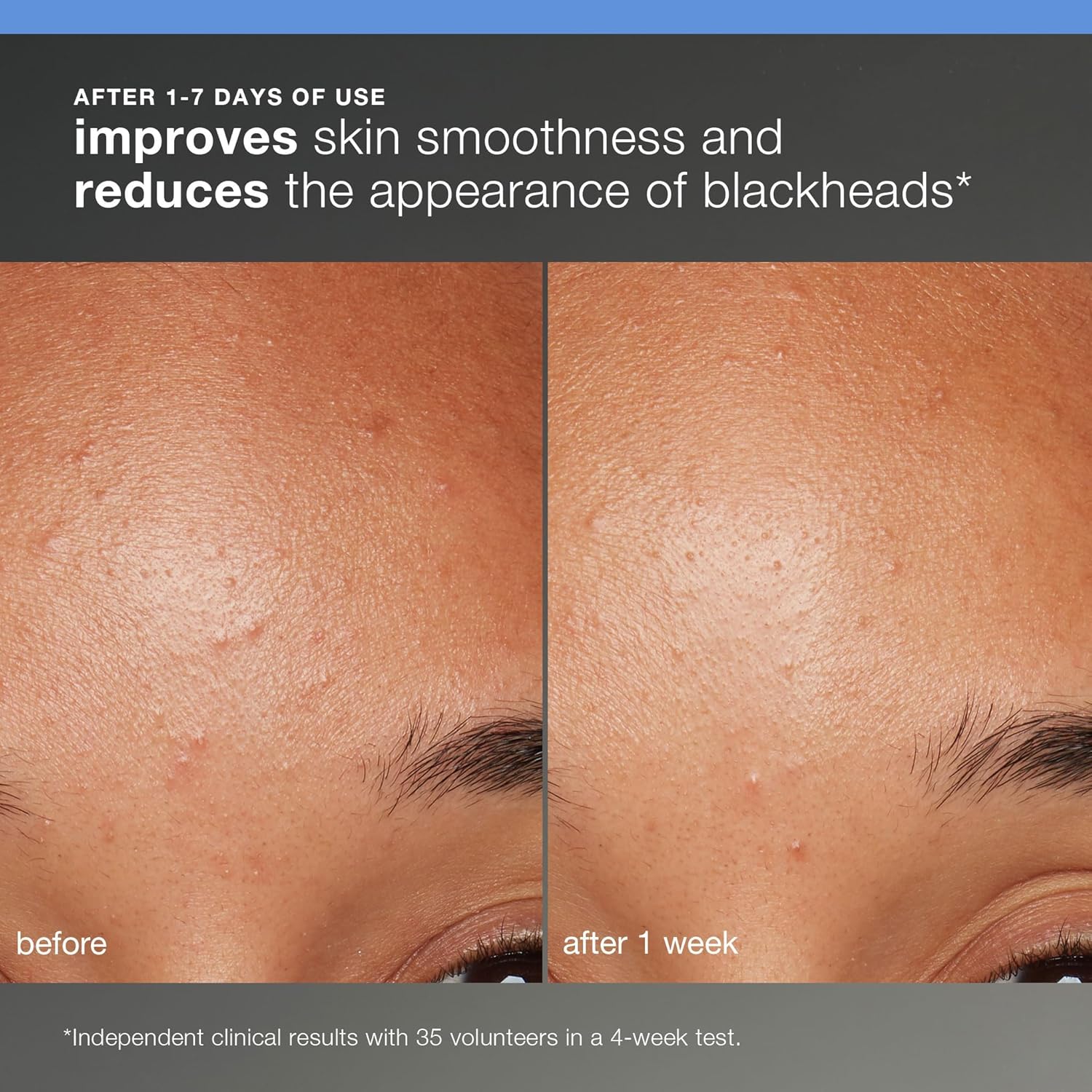 Dermalogica Discover Healthy Skin Kit - Includes: Precleanse, Face Wash, Face Exfoliator, & Moisturizer - Wash Away Impurities To Reveal Glowing Skin - Image 5