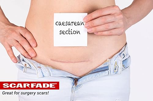 Miniatura 9 de Scarfade Elite - Tratamiento avanzado para cicatrices, eliminación de cicatrices, terapia de cicatrices, gel de prevención de cicatrices con