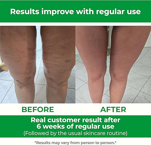 Miniatura 7 de TESMED Masajeador de celulitis eficacia clínicamente probada, fabricado en Italia, masajeador anticelulítico con tecnología de rodillo convergente y