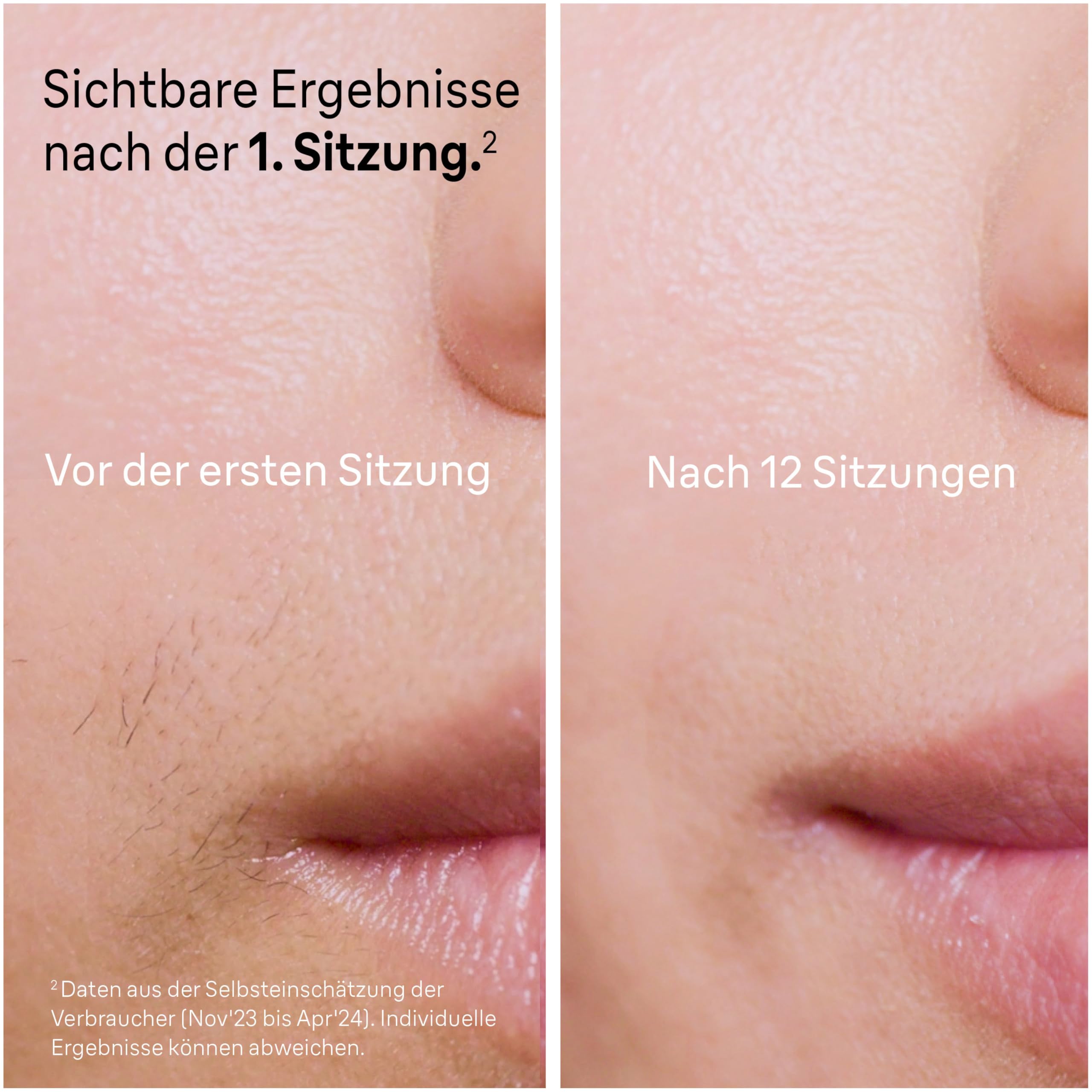 Braun Smart IPL Geräte Haarentfernung Skin i·expert 7, PL7387, Weiß/Rosegold - Alternative Laser Haarentfernung für Zuhause, Dauerhafte Haarentfernung, Inkl. Etui, Venus Rasierer Und 4 Aufsätze - 4