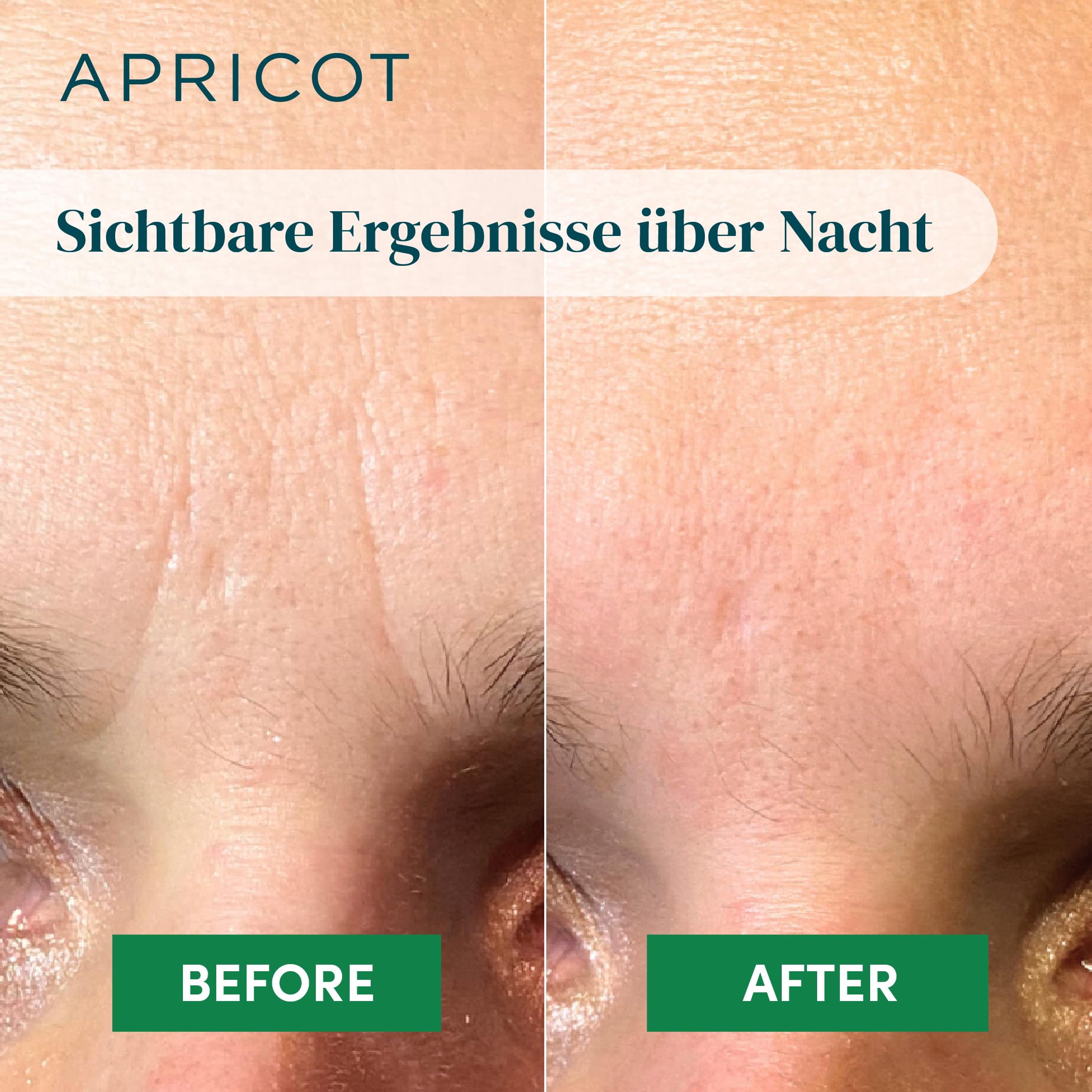 APRICOT “aloe vera“ Zornesfalten Pflaster I Facial Patches zur Minderung von Zornesfalten, mit Aloe vera I Anti Falten Pflaster 60 Stck. I Wrinkle Patches Faltenpflaster