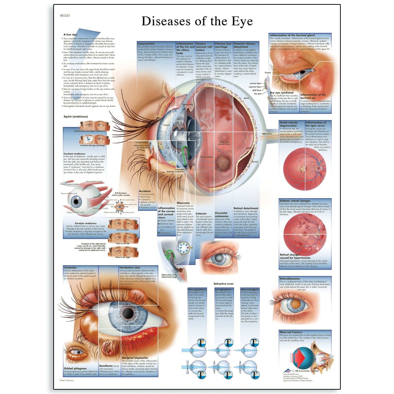 3B Scientific Human Anatomy - Diseases of the Eye Chart, Laminated Version, 1001498