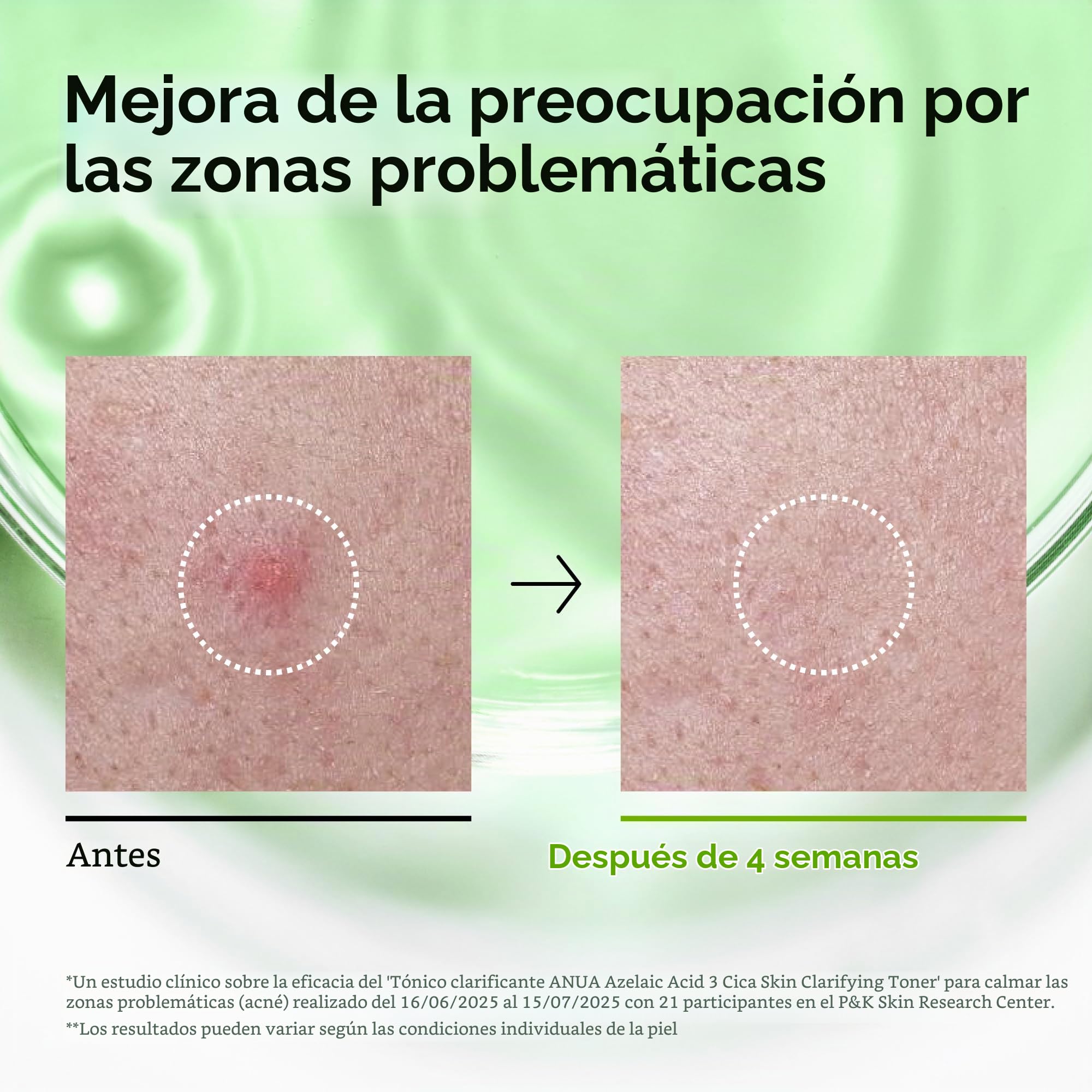 Anua Azelaic Acid 3 CICA Skin Clarifying Toner, Tónico Facial Calmante y Purificante, con Ácido Salicílico y Ácido Azelaico, Cuidado de la grasa y Imperfecciones, skincare coreano, 250 ml