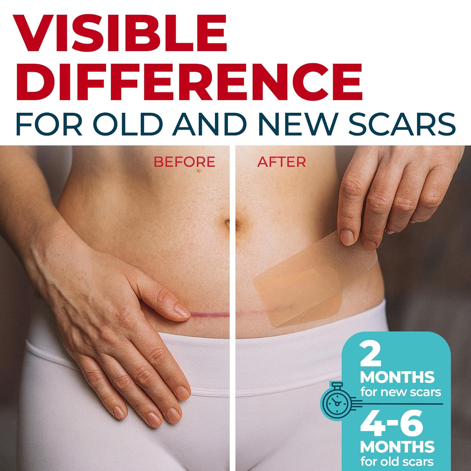 Medical Grade Silicone Scar Sheets - 4pk (5.7”x1.6”) - Visible Difference on Surgical & Keloid Scars - Reusable C-Section Scar Silicone Strips - Easy to Use Silicone Sheets for Scars - Image 2