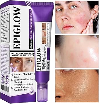 Epiglow Melanex Advanced Anti-Hyperpigmentation Cream, For HyperpigmentationTreatment, DarkSpot Remover Cream For All Type Skin (3PCS)