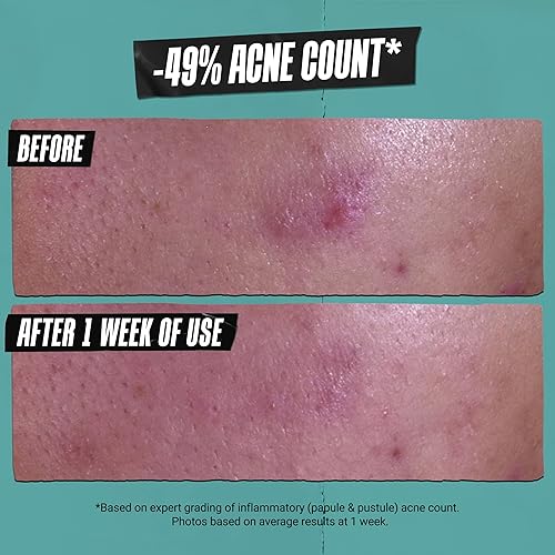 Miniatura 4 de Kiehl's Pasta limpiadora para el acné, con ácido salicílico, producto multiusos para limpiador, tratamiento de manchas y mascarilla facial, no seca