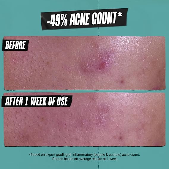 Kiehl's - Acne-Treating Cleansing Paste - Clears Breakouts - 4.2 fl oz