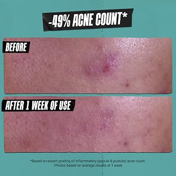 Kiehl's - Acne-Treating Cleansing Paste - Clears Breakouts - 4.2 fl oz