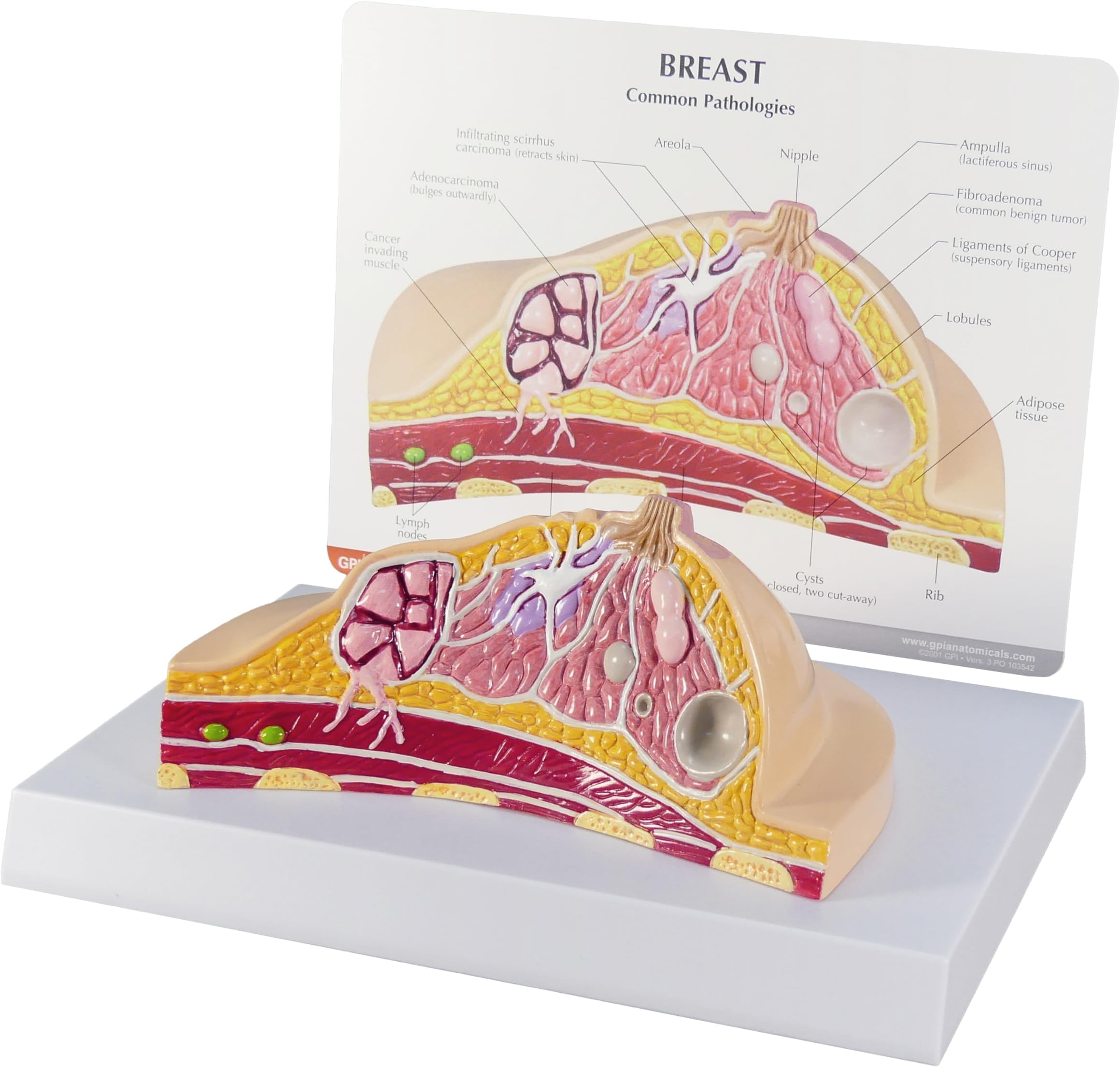 GPI Anatomicals - Breast Cross-Section Model, Replica Showing Common Pathologies for Human Anatomy, Physiology Education, Anatomy Model for Doctor's Offices and Classrooms, Medical Learning Resources