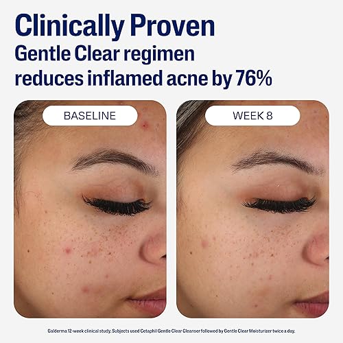 Miniatura 6 de Cetaphil Hidratante facial hidratante suave y transparente para el acné con 05 de ácido salicílico hidrata y trata la piel sensible propensa al acné