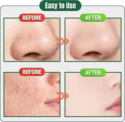 Miniatura 5 de Usiveinborn - Removedor de puntos negros mejorado, pinzas Usiveinborn para puntos negros, pinzas profesionales mejoradas para eliminar puntos