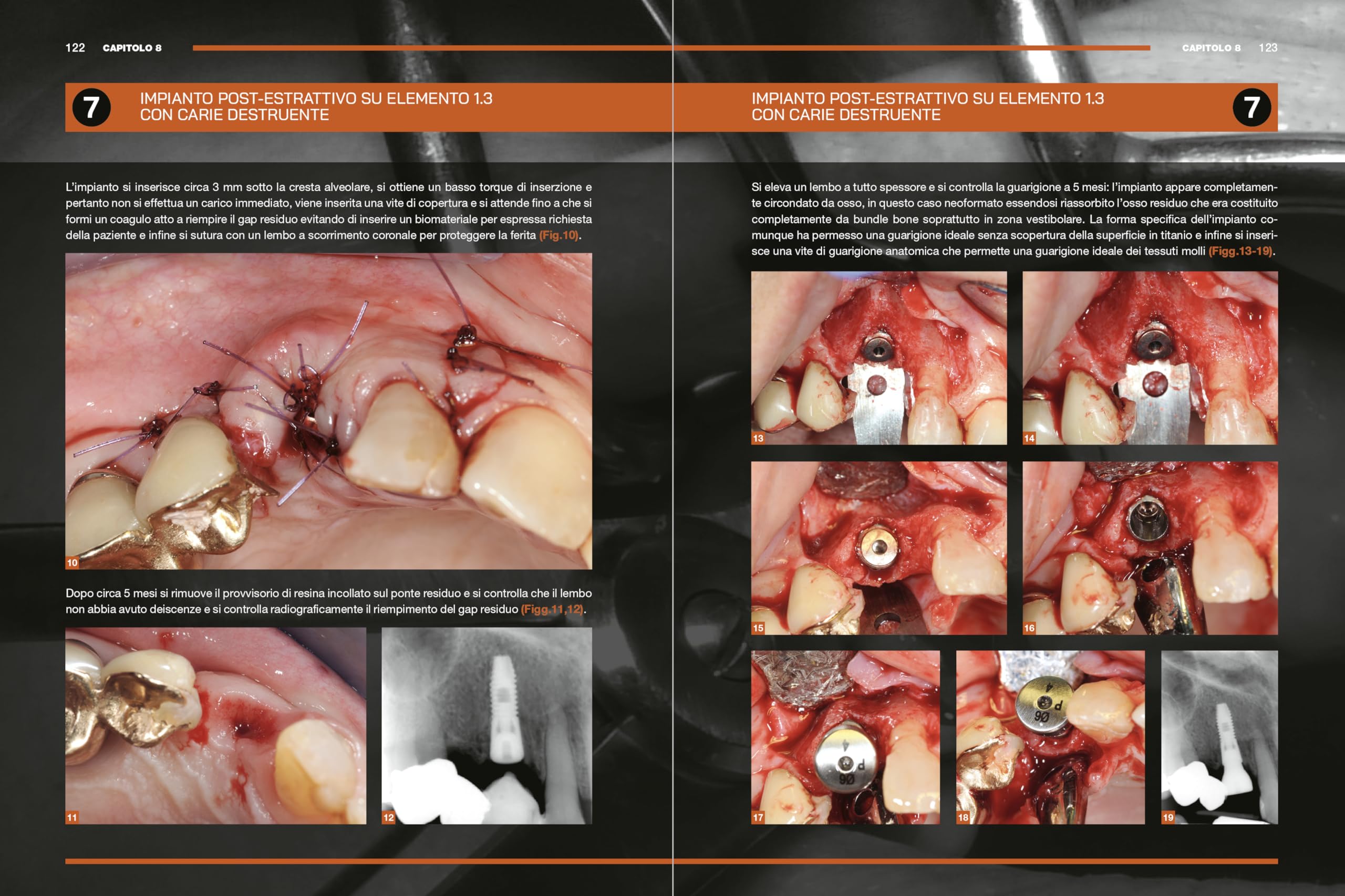 Impianti immediati. Manuale clinico operativo con procedure step by step