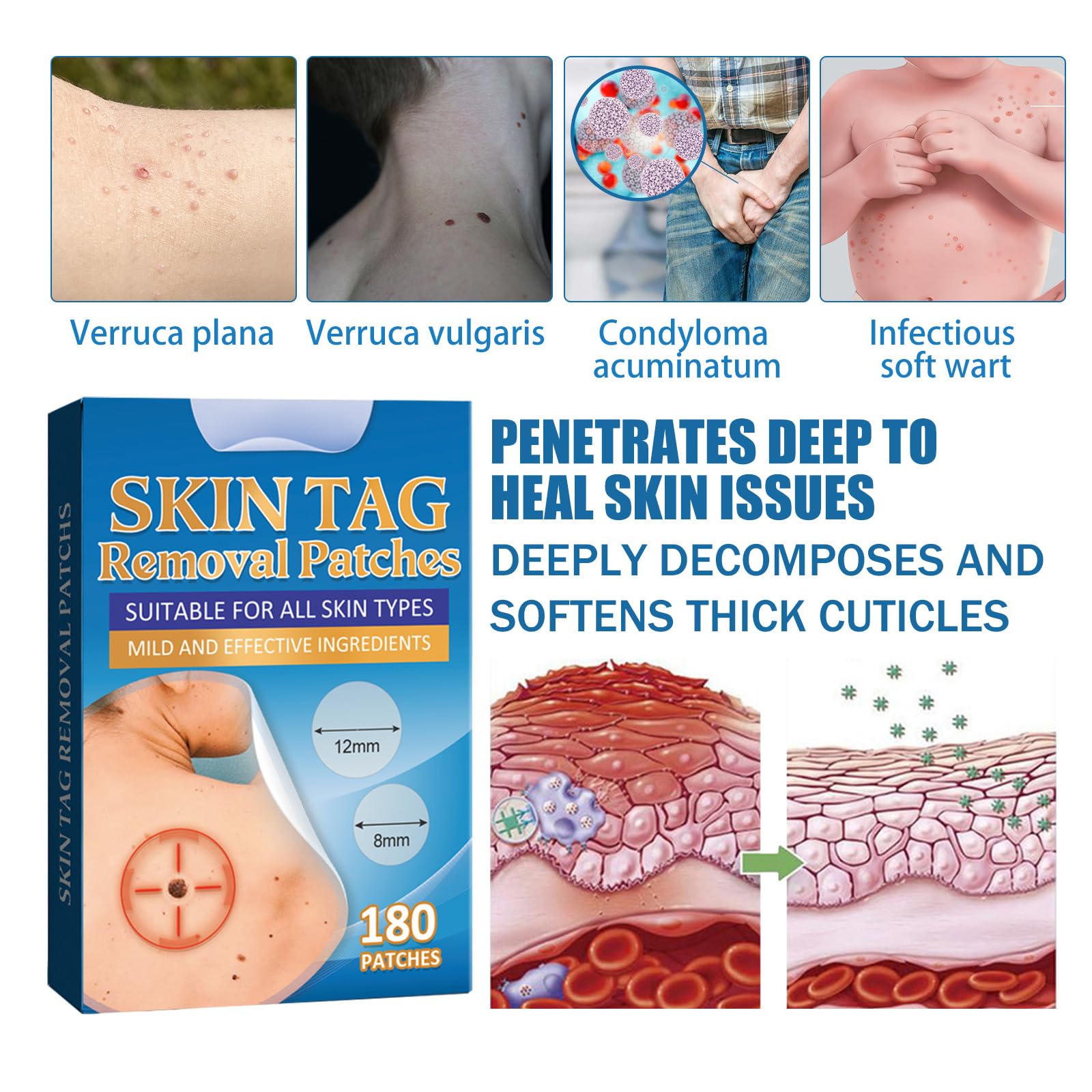 Anti Verrues,Traitement Verrues Plantaires,Patches Contre l’Acné,Wart Remover,Patch Anti Acrochordons,Détartrant Les Verrues Pour Les Mains et Les Pieds,180PC