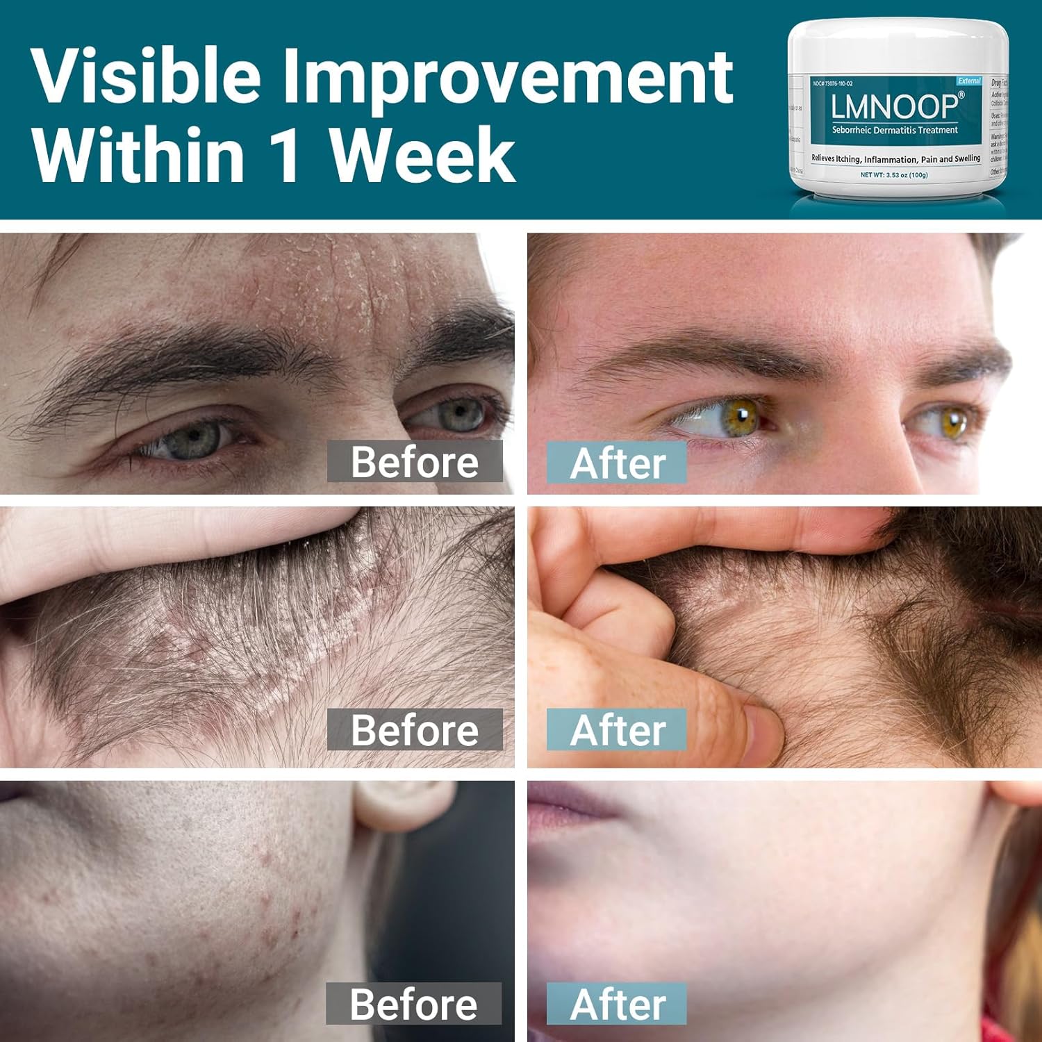 Seborrheic Dermatitis Cream, Extra Strength Scalp Treatment for Psoriasis, Folliculitis, Eczema, Dry Scalp, Dandruff, Anti-Itch and Soothing Skin 3.53 OZ - Image 3