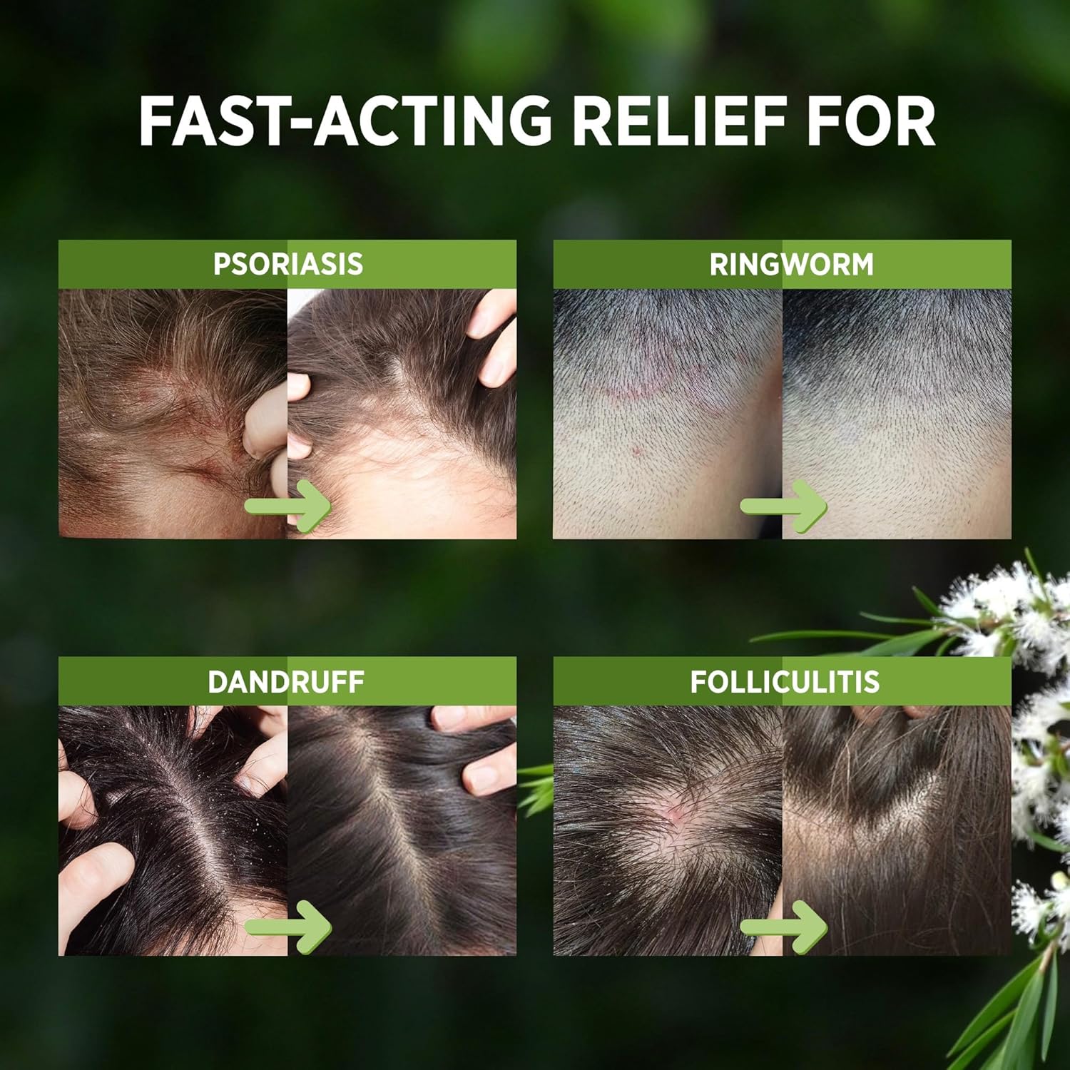 RoyceDerm Tea Tree Scalp Relief Spray: Leave-In Scalp Care for Dry, Flaky, and Itchy Scalp - Tea Tree Oil Formula for Comfort, Hydration, and Balance - Conditioning Support for Women & Men image 3 of 7 B0DQ2JHMJG