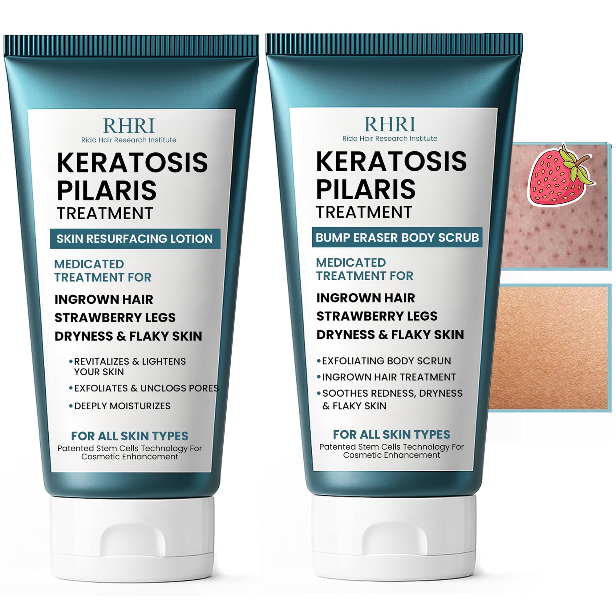 KP Bump Eraser Body Scrub + Keratosis Pilaris Lotion Bundle Set, Keratosis Pilaris Treatment, Strawberry Legs Treatment for Women, Bump Eraser Body Scrub, Keratosis Pilaris, Body Scrub for Strawberry